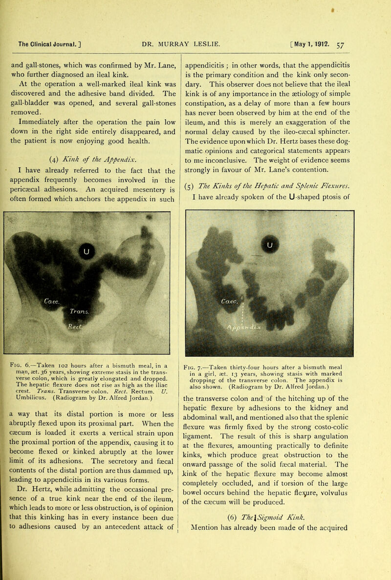 and gall-stones, which was confirmed by Mr. Lane, who further diagnosed an ileal kink. At the operation a well-marked ileal kink was discovered and the adhesive band divided. The gall-bladder was opened, and several gall-stones removed. Immediately after the operation the pain low down in the right side entirely disappeared, and the patient is now enjoying good health. (4) Kink of the Appendix. I have already referred to the fact that the appendix frequently becomes involved in the pericsecal adhesions. An acquired mesentery is often formed which anchors the appendix in such appendicitis ; in other words, that the appendicitis is the primary condition and the kink only secon- dary. This observer does not believe that the ileal kink is of any importance in the aetiology of simple constipation, as a delay of more than a few hours has never been observed by him at the end of the ileum, and this is merely an exaggeration of the normal delay caused by the ileo-csecal sphincter. The evidence upon which Dr. Hertz bases these dog- matic opinions and categorical statements appears to me inconclusive. The weight of evidence seems strongly in favour of Mr. Lane’s contention. (5) The Kinks of the Hepatic and Splenic Flexures. I have already spoken of the U-shaped ptosis of Fig. 6.—Taken 102 hours after a bismuth meal, in a man, aet. 36 years, showing extreme stasis in the trans- verse colon, which is greatly elongated and dropped. The hepatic flexure does not rise as high as the iliac crest. Trans. Transverse colon. Rect. Rectum. U. Umbilicus. (Radiogram by Dr. Alfred Jordan.) a way that its distal portion is more or less abruptly flexed upon its proximal part. When the caecum is loaded it exerts a vertical strain upon the proximal portion of the appendix, causing it to become flexed or kinked abruptly at the lower limit of its adhesions. The secretory and faecal contents of the distal portion are thus dammed up, leading to appendicitis in its various forms. Dr. Hertz, while admitting the occasional pre- sence of a true kink near the end of the ileum, which leads to more or less obstruction, is of opinion that this kinking has in every instance been due to adhesions caused by an antecedent attack of Fig. 7.—Taken thirty-four hours after a bismuth meal in a girl, set. 13 years, showing stasis with marked dropping of the transverse colon. The appendix is also shown. (Radiogram by Dr. Alfred Jordan.) the transverse colon and of the hitching up of the hepatic flexure by adhesions to the kidney and abdominal wall, and mentioned also that the splenic flexure was firmly fixed by the strong costo-colic ligament. The result of this is sharp angulation at the flexures, amounting practically to definite kinks, which produce great obstruction to the onward passage of the solid fecal material. The Link of the hepatic flexure may become almost completely occluded, and if torsion of the large bowel occurs behind the hepatic flexure, volvulus of the caecum will be produced. (6) The l Sigmoid Kink. Mention has already been made of the acquired