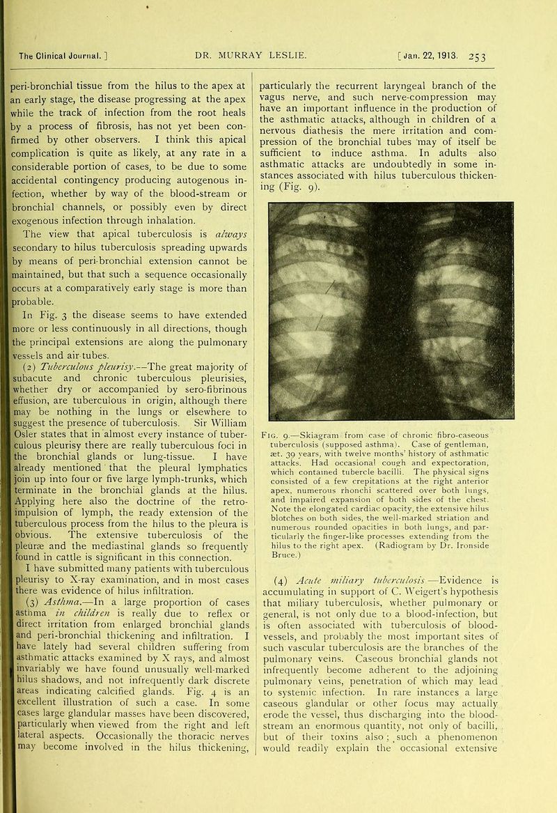 peri-bronchial tissue from the hilus to the apex at an early stage, the disease progressing at the apex while the track of infection from the root heals by a process of fibrosis, has not yet been con- firmed by other observers. I think this apical complication is quite as likely, at any rate in a considerable portion of cases, to be due to some accidental contingency producing autogenous in- fection, whether by way of the blood-stream or bronchial channels, or possibly even by direct j exogenous infection through inhalation. The view that apical tuberculosis is always \ secondary to hilus tuberculosis spreading upwards | by means of peri-bronchial extension cannot be maintained, but that such a sequence occasionally occurs at a comparatively early stage is more than probable. In Fig. 3 the disease seems to have extended more or less continuously in all directions, though the principal extensions are along the pulmonary vessels and air-tubes. (2) Tuberculous pleurisy.—The great majority of subacute and chronic tuberculous pleurisies, | whether dry or accompanied by sero-fibrinous ' effusion, are tuberculous in origin, although there ' may be nothing in the lungs or elsewhere to suggest the presence of tuberculosis. Sir William Osier states that in almost every instance of tuber- culous pleurisy there are really tuberculous foci in the bronchial glands or lung-tissue. I have already mentioned' that the pleural lymphatics join up into four or five large lymph-trunks, which terminate in the bronchial glands at the hilus. Applying here also the doctrine of the retro- impulsion of lymph, the ready extension of the tuberculous process from the hilus to the pleura is obvious. The extensive tuberculosis of the pleurae and the mediastinal glands so frequently found in cattle is significant in this connection. I have submitted many patients with tuberculous pleurisy to X-ray examination, and in most cases there was evidence of hilus infiltration. (3) Asthma.—In a large proportion of cases asthma in children is really due to reflex or direct irritation from enlarged bronchial glands and peri-bronchial thickening and infiltration. I have lately had several children suffering from asthmatic attacks examined by X rays, and almost invariably we have found unusually well-marked hilus shadows, and not infrequently dark discrete areas indicating calcified glands. Fig. 4 is an excellent illustration of such a case. In some I cases large glandular masses have been discovered, I particularly when viewed from the right and left I lateral aspects. Occasionally the thoracic nerves jmay become involved in the hilus thickening. particularly the recurrent laryngeal branch of the vagus nerve, and such nerve-compression may have an important influence in the production of the asthmatic attacks, although in children of a nervous diathesis the mere irritation and com- pression of the bronchial tubes may of itself be sufficient to induce asthma. In adults also asthmatic attacks are undoubtedly in some in- stances associated with hilus tuberculous thicken- ing (Fig. 9). Fig. 9.—Skiagram from case of chronic fibro-caseous tuberculosis (supposed asthma). Case of gentleman, aet. 39 years, with twelve months’ history of asthmatic attacks. Had occasional cough and expectoration, which contained tubercle bacilli. The physical signs consisted of a few crepitations at the right anterior apex, numerous rhonchi scattered over both lungs, and impaired expansion of both sides of the chest. Note the elongated cardiac opacity, the extensive hilus blotches on both sides, the well-marked striation and numerous rounded opacities in both lungs, and par- ticularly the finger-like processes extending from the hilus to the right apex. (Radiogram by Dr. Ironside Bruce.) (4) Acute miliary tuberculosis.—Evidence is accumulating in support of C. I\'eigert’s hypothesis that miliary tuberculosis, whether pulmonary or general, is not only due to a blood-infection, but is often associated with tuberculosis of blood- vessels, and probably the most important sites of such vascular tuberculosis are the branches of the pulmonary veins. Caseous bronchial glands not infrequently become adherent to the adjoining pulmonary veins, penetration of which may lead to systemic infection. In rare instances a large caseous glandular or other focus may actually erode the vessel, thus discharging into the blood- stream an enormous quantity, not only of bacilli, but of their toxins also;_such a phenomenon would readily explain the occasional extensive