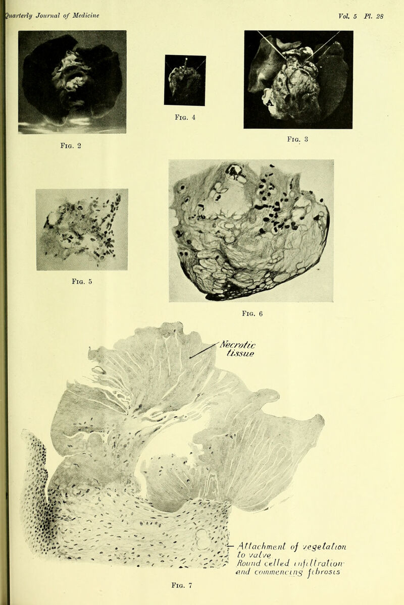 Fig. 2 Fig. 3 %'/> Fig. 6 • ••N If > - X y/E. s ,4 o i # ; o /> - ,bf»tA 'acv * 1 4 , : -> ; 9 ■ Co* - */ : y*$ We £ A.; 0/ 0* 6> ' ■ - - /•*»4** •• * > - r :-v * <U* IM ^ ' f f e 0 -’S of vegetation i nji It ration- ing fibrosis