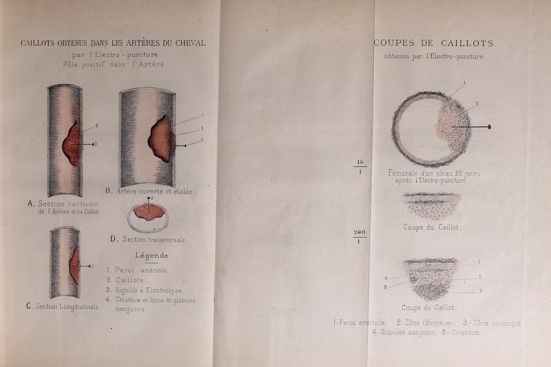 CAILLOTS OBTENUS DANS LES ARTERES DU CHEVAL par l'Electro - puncture Pôle positif dans l'Artère. A C rtère ouverte et étalée . Section verticale, de l'Artère et du Caillot. D . Section transversale . Légende Section Longitudinale. 1. Paroi artérielle. 2. Caillots . 3. Aiguille à Electrolyse. 4. Cristaux et blocs de globules sanguins. COUPES DE CAILLOTS obtenus par l’Electro-puncture . Fémorale d'un chien 25 jours après l'Electro -puncture. 260 Coupe du Caillot Coupe du Caillot. -Paroi artérielle. 2.-Zone fibrineuse. 3-Zone cruorique. 4.- Globules sanguins. 5r Cristaux.