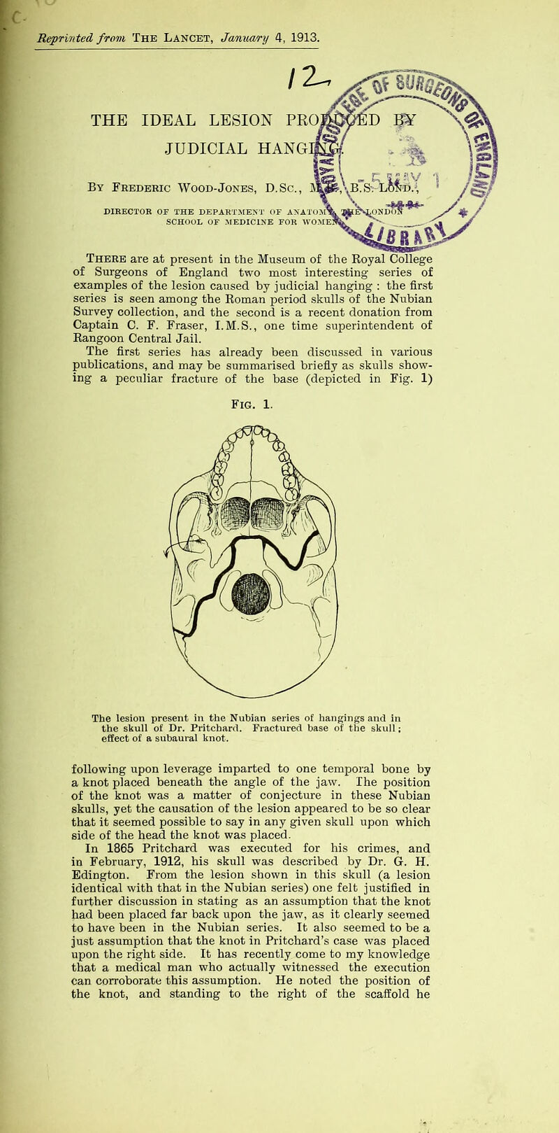 c Reprinted from The Lancet, Jamiary 4, 1913. There are at present in the Museum of the Royal College of Surgeons of England two most interesting series of examples of the lesion caused by judicial hanging : the first series is seen among the Roman period skulls of the Nubian Survey collection, and the second is a recent donation from Captain C. F. Fraser, I.M.S., one time superintendent of Rangoon Central Jail. The first series has already been discussed in various publications, and may be summarised briefly as skulls show- ing a peculiar fracture of the base (depicted in Fig. 1) Fig. 1. The lesion present in the Nubian series of hangings and in the skull of Dr. Pritchard. Fractured base of the skull; effect of a subaural knot. following upon leverage imparted to one temporal bone by a knot placed beneath the angle of the jaw. Ihe position of the knot was a matter of conjecture in these Nubian skulls, yet the causation of the lesion appeared to be so clear that it seemed possible to say in any given skull upon which side of the head the knot was placed. In 1865 Pritchard was executed for his crimes, and in February, 1912, his skull was described by Dr. G. H. Edington. From the lesion shown in this skull (a lesion identical with that in the Nubian series) one felt justified in further discussion in stating as an assumption that the knot had been placed far back upon the jaw, as it clearly seemed to have been in the Nubian series. It also seemed to be a just assumption that the knot in Pritchard’s case was placed upon the right side. It has recently come to my knowledge that a medical man who actually witnessed the execution can corroborate this assumption. He noted the position of the knot, and standing to the right of the scaffold he