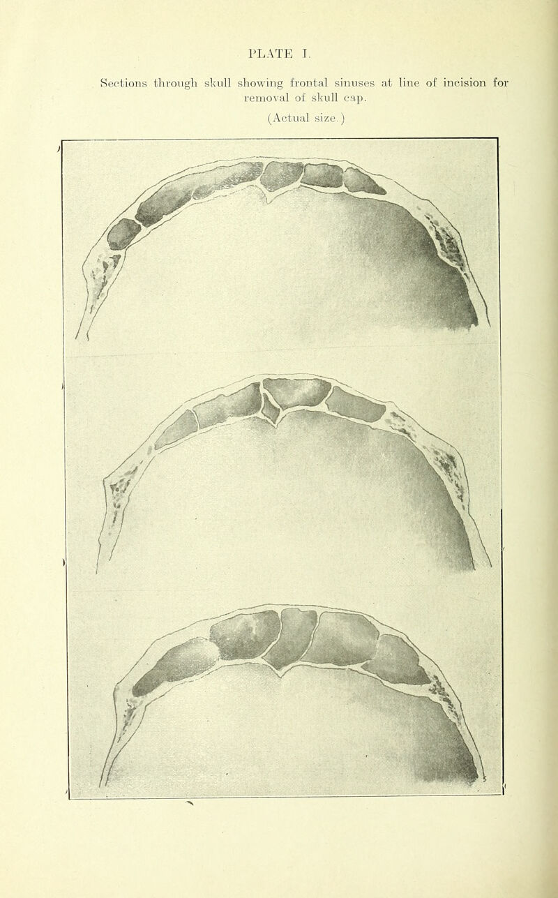 Sections througli skull showing frontal sinuses at line of incision for removal of skull cap. (Actual size.)