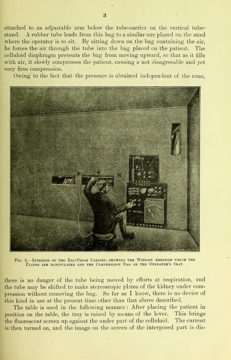 attached to an adjustable arm below the tube-carrier ou the vertical tube- stand. A rubber tube leads from this bag to a similar one placed on the stool where the operator is to sit. By sitting down on the bag containing the air, he forces the air through the tube into the bag placed on the patient. The celluloid diaphragm prevents the bag from moving upward, so that as it fdls Avith air, it sloAAdy compresses the patient, causing a not disagreealile and yet ver}^ firm compression. Owing to the fact that the pressure is obtained independent of the cone. Fig. 2.—Interior of the Ray-Proof Cabinet, showing the Window through which the Plates are manipulated and the Compression Bag on the Operator’s Seat. there is no danger of the tid3e being moved by efforts at respiration, and the tube may be shifted to make stereoscopic plates of the kidney under com- pression without removiug the bag. So far as I know, there is no device of this kind in use at the present time other than that above described. The table is used in the following manner: After placing the patient in position on the table, the tray is raised by means of the lever. This brings the fluorescent screen up against the under part of the celluloid. The current is then turned on, and the image on the screen of the interposed part is dis-
