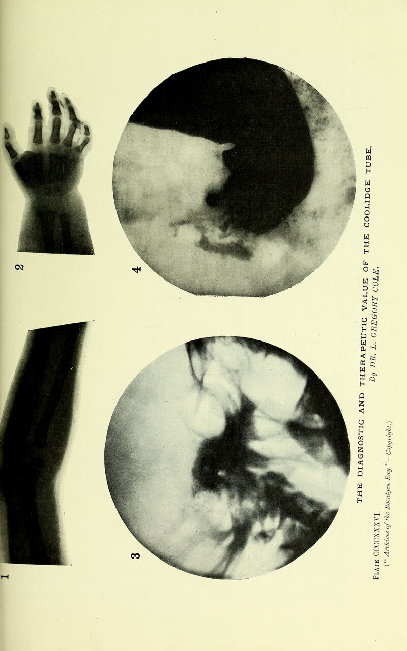 THE DIAGNOSTIC AND THERAPEUTIC VALUE OF THE COOLIDGE TUBE, Plate CCCCXXXVI. G^^EGOBY COLE. (“ Archives of the Roentgen Ray—Copyright.)