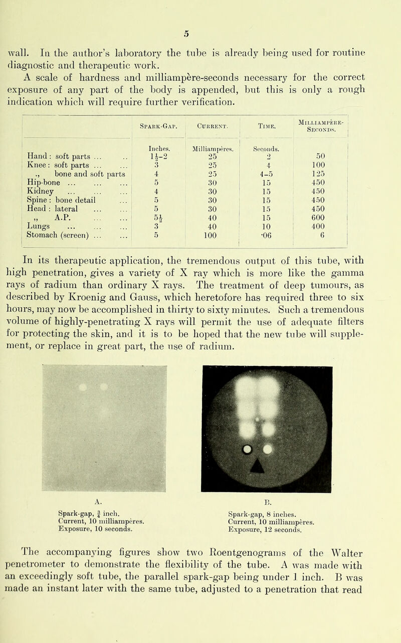 wall. Ill the author’s laboratory the tube is already being used for routine diagnostic and therapeutic work. A scale of hardness and milliampere-seconds necessary for the correct exposure of any jiart of the body is appended, hut this is only a rough indication which will require further verification. Spark-Gap. Current. Time. Mii.liampere- Seconds. Hand : soft parts ... Inches. U-2 Milliamperes. 25 Seconds. 2 50 Knee : soft parts ... 3 25 4 100 bone and soft parts Hip-bone ... 4 25 4-5 125 5 30 15 450 Kidney 4 30 15 450 Spine : bone detail 5 30 15 450 Head : lateral 5 30 15 450 „ A.P H 40 15 600 Lungs 3 40 10 400 Stomach (screen) ... 5 100 ■06 6 In its therapeutic application, the tremendous output of this tube, with high penetration, gives a variety of X ray which is more like the gamma rays of radium than ordinary X rays. The treatment of deep tumours, as described by Kroenig and Gauss, which heretofore has required three to six hours, may now be accomplished in thirty to sixty minutes. Such a tremendous volume of highly-penetrating X rays will permit the use of adequate filters for protecting the skin, and it is to be hoped that the new tube will supple- ment, or replace in great part, the use of radium. A. Spark-gap, inch. Current, 10 niilliamperes. Exposure, 10 seconds. B. Spark-gap, 8 inches. Current, 10 milliamperes. Exposure, 12 seconds. The accompanying figures show two Roentgenograms of the Walter penetrometer to demonstrate the flexiliility of the tube. A was made with an exceedingly soft tube, the parallel spark-gap being under I inch. B was made an instant later with the same tube, adjusted to a penetration that read