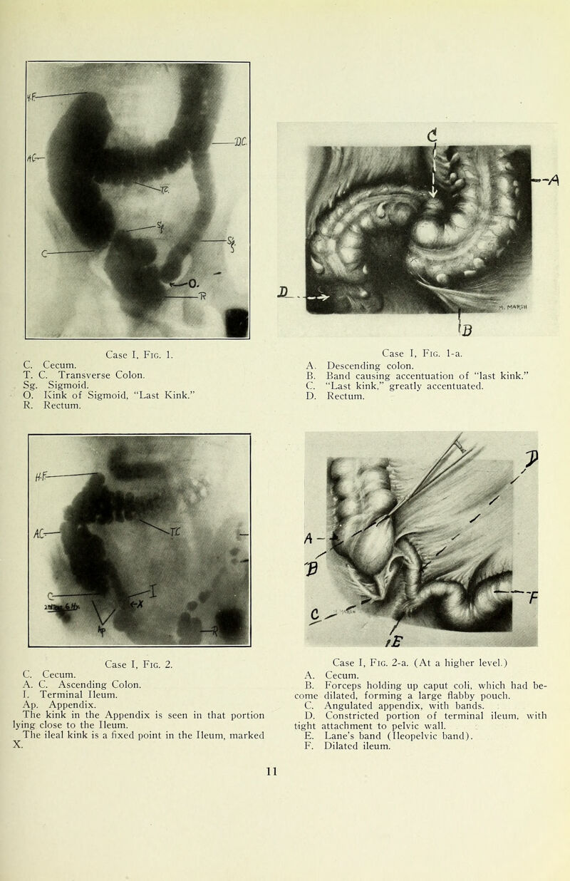 C. Cecum. T. C. Transverse Colon. Sg. Sigmoid. O. Kink of Sigmoid, “Last Kink.’’ R. Rectum. A. Descending colon. B. Band causing accentuation of “last kink.” C. “Last kink,” greatly accentuated. D. Rectum. Case I, Fig. 2. C. Cecum. A. C. Ascending Colon. I. Terminal Ileum. Ap. Appendix. The kink in the Appendix is seen in that portion lying close to the Ileum. The ileal kink is a fixed point in the Ileum, marked X. Case I, Fig. 2-a. (At a higher level.) A. Cecum. B. Forceps holding up caput coli, which had be- come dilated, forming a large flabby pouch. C. Angulated appendix, with bands. D. Constricted portion of terminal ileum, with tight attachment to pelvic wall. E. Lane’s band (Ileopelvic band). F. Dilated ileum.