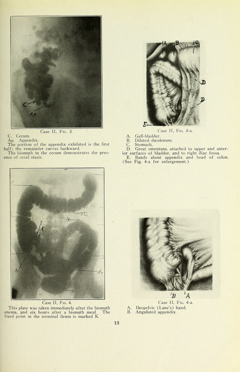 C. Cecum. Ap. Appendix. The portion of the appendix exhibited is the first half; the remainder curves backward. The bismuth in the cecum demonstrates the pres- ence of cecal stasis. Case II, Fig. 4. This plate was taken immediately after the bismuth enema, and six hours after a bismuth meal. The fixed point in the terminal ileum is marked K. A. Gall-bladder. B. Dilated duodenum. C. Stomach. D. Great omentum, attached to upper and anter- ior surfaces of bladder, and to right iliac fossa. E. Bands about appendix and head of colon. (See Fig. 4-a for enlargement.) Case II, Fig. 4-a. A. Ileopelvic (Lane’s) band. B. Angulated appendix.
