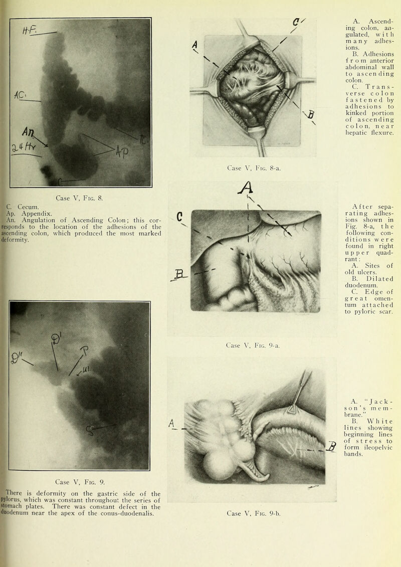 C. Cecum. Ap. Appendix. An. Angulation of Ascending Colon; this cor- responds to the location of the adhesions of the ascending colon, which produced the most marked deformity. Case V, Fig. 9. There is deformity on the gastric side of the pylorus, which was constant throughout the series of stomach plates. There was constant defect in the duodenum near the apex of the conus-duodenalis. Case V, Fig. 8-a. A. Ascend- ing colon, an- gulated, with many adhes- ions. B. Adhesions from anterior abdominal wall to ascending colon. C. Trans- verse colon fastened by adhesions to kinked portion of ascending colon, near hepatic flexure. After sepa- rating adhes- ions shown in Fig. 8-a, the following con- ditions were found in right upper quad- rant : A. Sites of old ulcers. B. Dilated duodenum. C. Edge of great omen- tum attached to pyloric scar. Case V, Fig. 9-a. A. “Jack- son’s m e m - brane.’’ B. W h i t e lines showing beginning lines of stress to form ileopelvic bands. Case V, Fig. 9-b.