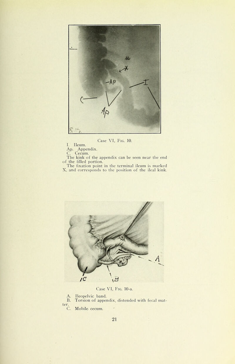 I. Ileum. Ap. Appendix. C. Cecum. The kink of the appendix can be seen near the end of the filled portion. The fixation point in the terminal ileum is marked X, and corresponds to the position of the ileal kink. Case VI, Fig. 10-a. A. Ileopelvic band. B. Torsion of appendix, distended with fecal mat- ter. C. Mobile cecum. 21