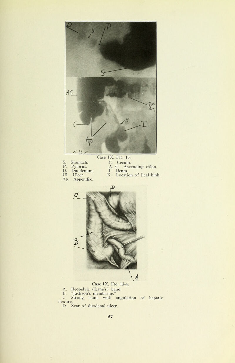 Case IX, Fig. 13. s. Stomach. C. Cecum. p. Pylorus. A. C. Ascending colon. D. Duodenum. I. Ileum. Ul. Ulcer. K. Location of ileal kink Ap. Appendix. Case IX. Fig. 13-a. A. lleopelvic (Lane’s) band. B. “Jackson’s membrane.” C. Strong band, with angulation of hepatic flexure. D. Scar of duodenal ulcer.