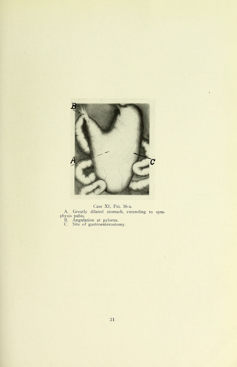 Case XI, Fig. 16-a. A. Greatly dilated stomach, extending to sym- physis pubis. B. Angulation at pylorus. C. Site of gastroenterostomy.