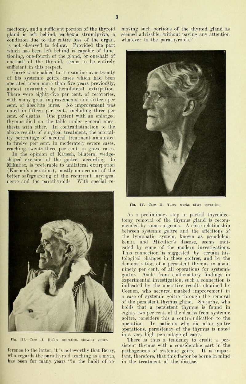 mectomy, and a sufficient portion of the thyroid gland is left behind, cachexia strumipriva, a condition due to the entire loss of the organ, is not observed to follow. Provided the part which has been left behind is capable of func- tioning, one-fourth of the gland, or one-half of one-half of the thyroid, seems to be entirely sufficient in this respect. Garre was enabled to re-examine over twenty of his systemic goitre cases which had been operated upon more than five years previously, almost invariably by hemilateral extirpation. There were eighty-five per cent, of recoveries, with many great improvements, and sixteen per cent, of absolute cures. No improvement was noted in fifteen per cent., including three per cent, of deaths. One patient with an enlarged fliymus died on the table under general anes- thesia with ether. Tn contradistinction to the above results of surgical treatment, the mortal- ity percentage of medical treatment amounted to twelve per cent, in moderately severe cases, reaching twenty-three per cent, in grave cases. In the opinion of Kausch, bilateral wedge- shaped excision of the goitre, according to Mikulicz, is preferable to unilateral extirpation (Kocher’s operation), mostly on account of the better safeguarding of the recurrent laryngeal nerve and the parathyroids. With special re- Fig. Ill,—Case II. Ilefm’e oixM’atinii, showing goitre. fcrence to the latter, it is noteworthy that Berry, who regards the parathyroid teaching as a myth, has been for many years “in the habit of re- moving such portions of the thyroid gland as seemed advisable, without paying any attention whatever to the parathyroids.” Fig. IV.--Case II. Three weeks after operation. As a preliminary stejr in partial thyroidec- tomy removal of the thymus gland is recom- mended by some surgeons. A close relationship between systemic goitre and the affections of the lymphatic system, known as pseudoleu- kemia and Mikulicz’s disease, seems indi- cated by some of the modern investigations. This connection is suggested by certain his- tological changes in these goitres, and by the demonstration of a persistent thymus in about ninety per cent, of all operations for systemic goitre. Aside from confirmatory findings in experimental investigation, such a connection is indicated by the operative results obtained by Coenen, who secured marked improvement in a case of systemic goitre through ihe removal of the persistent thymus gland. Spijarny, who holds that a persistent thymus is found in eighty-two per cent, of the deaths from systemic goitre, considers this a contraindication to the operation. In patients who die after goitre operations, persistency of the thymus is noted in a very high percentage of cases. There is thus a tendency to credit a per- sistent thymus with a considerable part in the pathogenesis of systemic goitre. It is impor- tant, therefore, that this factor be borne in mind in the treatment of the disease.