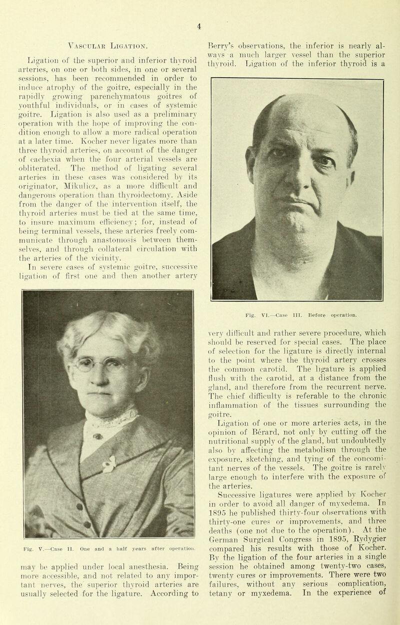 Vascular Ligation. Ijigation of tlie superior and inferior thyroid arteries, on one or both sides, in one or several sessions, has lieen recommended in order to induce atrophy of the goitre, especially in the rajiidly growing parenchymatous goitres of youthful individuals, or in cases of systemic goitre. Ligation is also used as a preliminary operation with the hope of improving the con- dition enough to allow a more radical operation at a later time. Kocher never ligates more than three thyroid arteries, on account of the danger of cachexia when the four arterial vessels are obliterated. The method of ligating several arteries in these cases was considered by its origiiiator, Mikulicz, as a more difficult and dangerous operation than thyroidectomy. Aside from the danger of the intervention itself, the thyroid arteries must he tied at the same time, to insure maximum efficiency; for, instead of being terminal vessels, these arteries freely com- municate through anastomosis between them- selves, and through collateral circulation with the arteries of the vicinity. Tn severe cases of systemic goitre, successive ligation of first one and then another artery V.—Case II. One and a half years after operation. may he applied under local anesthesia. Being more accessible, and not related to any impor- tant nerves, the superior thyroid arteries are usually selected for the ligature. According to Berry’s observations, the inferior is nearly al- ways a much larger vessel than the superior thyroid. Ligation of the inferior thyroid is a Fig. VI.—Case III. Before operation. very difiicult and rather severe procedure, which should be reserved for siiecial cases. The place of selection for the ligature is directly internal to the point where the thyroid artery crosses the common carotid. The ligature is applied flush with the carotid, at a distance from the gland, and therefore from the recurrent nerve. The chief difficulty is referable to the chronic inflammation of the tissues surrounding the goitre. Ligation of one or more arteries acts, in the opinion of Berard, not only by cutting off the nutritional supply of the gland, but undoubtedly also by affecting the metabolism through the exposure, sketching, and tying of the concomi- tant nerves of the vessels. The goitre is rarely large enough to interfere with the exposure of the arteries. Successive ligatures were applied by Kocher in order to avoid all clanger of myxedema. In 1895 he published thirty-four observations with thirty-one cures or improvements, and three deaths (one not due to the operation). At the German Surgical Congress in 1895, Eydygier compared his results with those of Kocher. By the ligation of the four arteries in a single session he obtained among twenty-two cases, twenty cures or improvements. There were two failures, without any serious complication, tetany or myxedema. In the experience of