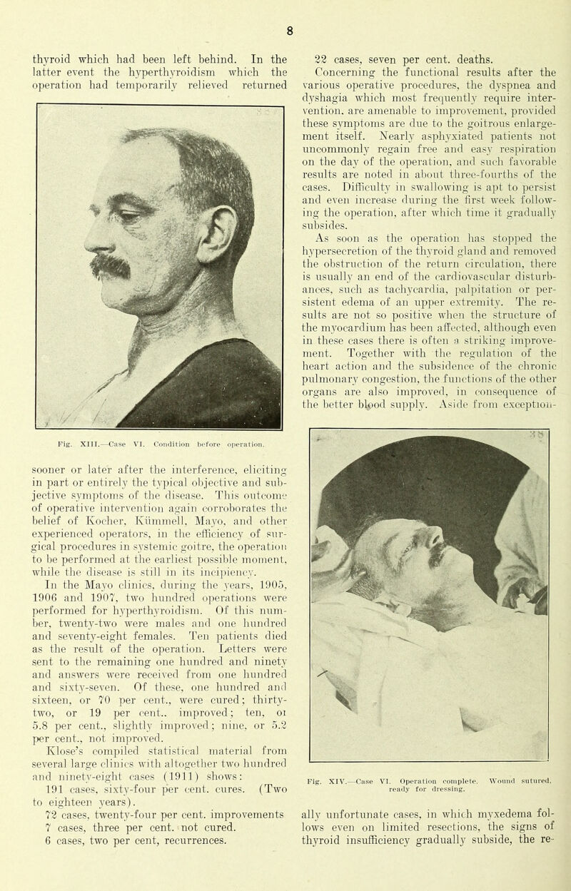 thyroid which had been left behind. In the latter event the hyperthyroidism which the operation had temporarily relieved returned Fig. XIII.—Case VI. Condition before operation. sooner or later after the interference, eliciting in part or entirely the typical oljjective and sub- jective symptoms of the disease. This outcome of operative interventio]i again corroborates tlie belief of Kochcr, Kummell. Mayo, and other experienced operators, in the efficiency of sur- gical procedures in systemic goitre, the operation to be performed at the earliest possible moment, while the disease is still in its incipiencv. In the Mayo clinics, during the years, 190.5, 1906 and 1907, two hundred operations were performed for hyperthyroidism. Of this num- ber, twenty-two were males and one hundred and seventy-eight females, d'en patients died as the result of the operation. Letters were sent to the remaining one hundred and ninety and answers were received from one hundred and sixty-seven. Of these, one hundred and sixteen, or 70 per cent., were cured; thirty- two, or 19 per cent., improved; ten, oi 5.8 per cent., .slightly improved; nine, or 5.2 per cent., not improved. Klose’s compiled statistical material from several large clinics with altogether two hundred and ninety-eight cases (1911) shows: 191 cases, sixty-four per cent, cures. (Two to eighteen years). 72 cases, twenty-four per cent, improvements 7 cases, three per cent, not cured. 6 cases, two per cent, recurrences. 22 cases, seven per cent, deaths. Concerning the functional results after the various operative procedures, the dyspnea and dyshagia which most frequently require inter- vention. are amenable to improvement, provided these symptoms are due to the goitrous enlarge- ment itself. Nearly asphyxiated patients not uncommonly regain free and easy respiration on the day of the operation, and such favorable results are noted in about three-fourths of the cases. Difficulty in swallowing is apt to persist and even increase dm’ing the first week follow- ing the operation, after which time it gradually subsides. As soon as the operation has stopped the hypersecretion of the thyroid gland and removed the obstruction of the return circulation, there is usually au end of the cardiovascular disturb- ances, such as tachycardia, palpitation or per- sistent edema of an upper extremity. The re- sults are not so positive when the structure of the myocardium has been affected, although even in these cases there is often a striking improve- ment. Together with the regulation of the heart action and the subsidence of the chronic pulmonary congestion, the functions of the other organs are also improved, in consequence of the better blood supply. Aside from exception- Fig. XIV.—Ctjse VI. Operation complete. Wound sutured, ready for dressing. ally unfortunate cases, in wliich myxedema fol- lows even on limited resections, the signs of thyroid insufficiency gradually subside, the re-