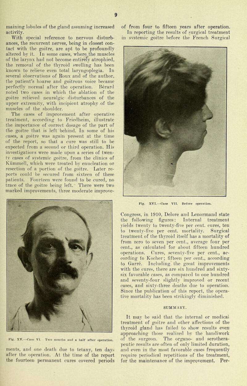 maining lobules of the gland assuming increased activity. With special reference to nervous disturb- ances, the recurrent nerves, being in closest con- tact with the goitre, are apt to be profoundly altered by it. In some cases, where the muscles of the larynx had not become entirefy atrophied, the removal of the thyroid swelling has been known to relieve even total lar^mgoplegia. In several observations of Eoux and of the author, the patient’s hoarse and goitrous voice became perfectly normal after the operation. Berard noted two eases in which the ablation of the goitre relieved neuralgic disturbances of the upper extremity, with incipient atrophy of the muscles of the shoulder. The cases of improvement after operative treatment, according to Friedheim, illustrate the importance of correct dosage of the part of the goitre that is left behind. In some of his cases, a goitre was again present at the time of the report, so that a cure was still to be expected from a second or third operation, tiis investigations were made upon a series of twen- ty cases of systemic goitre, from the clinics of Kiimmell, which were treated by enucleation or resection of a jrortion of the goitre. Later re- ports could be secured from sixteen of these patients. Fourteen were found to be cured, no trace of the goitre being left. There were two marked improvements, three moderate improve- Fij?. XV.—Case VI, 'J’wo inoiitlis and a half after operation. nients, and one death due to tetany, ten day.s after the operation. At the time of the report the fourteen permanent cures covered periods of from four to fifteen years after operation. In reporting the results of surgical treatment in svstemic goitre before the French Surgical Fig. XVI.—Case VII. Before operation. Congress, in 1910, Delore and Lenormand state the following figures: Internal treatment yields twenty to twenty-five per cent, cures, ten to twenty-five per cent, mortality. Surgical treatment of the thyroid itself has a mortality of from zero to seven per cent., average four per cent., as calculated for about fifteen hundred operations. Cures, seventy-five per cent., ac- cording to Kocher; fifteen per cent., according to Garre. Including the great improvements with the cures, there are six hundred and sixty- six favorable cases, as compared to one hundred and seventy-four slightly improved or recent cases, and sixty-three deaths due to operation. Since the publication of this report, the opera- tive mortality has been strikingly diminished. StTMMAUY. It may be said that the internal or medical treatment of goitre and other affections of the thyroid gland has failed to show results even approaching those realized by the handiwork of the surgeon. The organo- and serothera- peutic results are often of only limited duration, and even in the most favorable cases frequently require periodical repetitions of the treatment, for the maintenance of the improvement, Per-