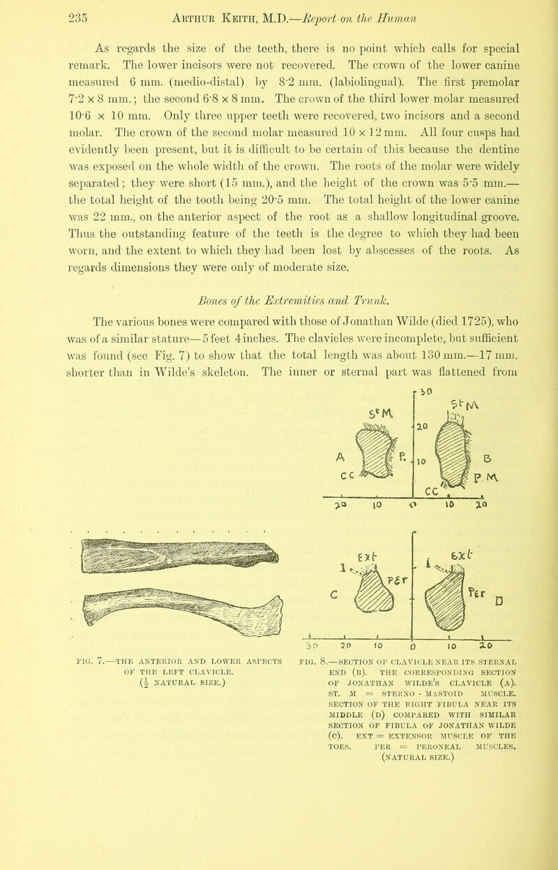 As regards the size of the teeth, there is no point which calls for special remark. The lower incisors were not recovered. The crown of the lower canine measured 6 mm. (medio-distal) by 8'2 mm. (labiohngual). The first premolar 7'2 X 8 mm.; the second 6‘8 x 8 mm. The crown of the third lower molar measured 10‘6 X 10 mm. Only three upper teeth were recovered, two incisors and a second molar. Tlie crown of the second molar measirred 10 x 12 mm. All four cusps had evidently been present, but it is difficult to be certain of this because the dentine was exposed on the whole width of the crown. The roots of the molar were widely separated; they were short (15 mm.), and the height of the crown was 5'5 mm.— the total height of the tooth being 20'5 mm. The total height of the lower canine was 22 mm., on the anterior aspect of the root as a shallow longitudinal groove. Thus the outstanding feature of the teeth is the degree to which they had been worn, and the extent to which they had been lost by abscesses of the roots. As regards dimensions they were only of moderate size. Bones of the Extremities and Trunk. The various bones were compared with those of Jonathan Wilde (died 1725), who was of a similar stature—5 feet 4 inches. Tlie clavicles were incomplete, but sufficient was found (see Fig. 7) to show that the total length was about 130 mm.—17 mm. shorter than in Wilde’s skeleton. The inner or sternal part was flattened from FIG. 7.—THE ANTERIOR AND LOWER ASPECTS OF THE LEFT CLAVICLE. (5 NATURAL SIZE.) FIG. 8.—SECTION OP CLAVICLE NEAR ITS STERNAL END (b). THE CORRESPONDING SECTION OF JONATHAN WILDE’s CLAVICLE (a). ST. M = STERNO - MASTOID MUSCLE. SECTION OF THE RIGHT FIBULA NEAR ITS MIDDLE (d) COMPARED WITH SIMILAR SECTION OF FIBULA OF JONATHAN WILDE (c). EXT = EXTENSOR MUSCLE OF THE TOES. PER = PERONEAL MUSCLES. (natural SIZE.)