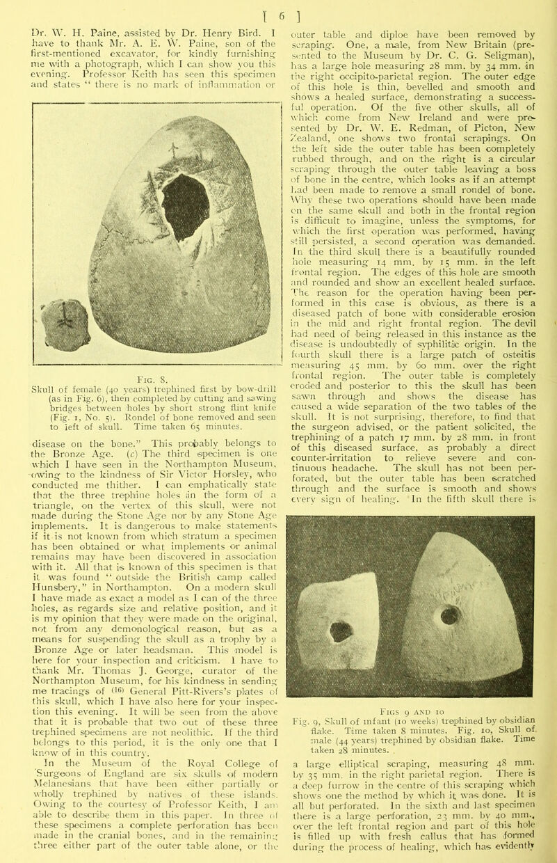 Dr. W. H. Paine, assisted by Dr. Henry Bird. I have to thank Mr. A. E. \V. Paine, son of the first-mentioned e.xcavator, for kindly furnishinq' me with a photograph, which I can show you this eveninq. Professor Keith has seen this specimen and states “ there is no mark of inflammation nr Fig. S. Skull of female (40 years) trephined first by bow-drill (as in Fig. 6), then completed .by cutting and sawing bridges between holes by short strong flint knife (Fig. I, No. 5). Kondel of bone removed and seen to left of skull. Time taken 65 minutes. disease on the bone.” This probably belongs to the Bronze Age. (c) The third ©pecimen is one which I have seen in the Northampton Museum, (Aving to the kindness of Sir ^Tctor Horsley, who conducted me thitlier. I can emphatically state that the three trephine holes lin the form of a triangle, on the vertex of this skull, were not made during the Stone Age nor by any Stone Age implements. It is dangerous to make statements if it is not known from which stratum a specimen has been obtained or what implements or animal remains may have been discovered in association with it. All that is known of this specimen is that it was found “ outside the British camp called Hunsbeiy,” in Northampton. On a modern skull I have made as exact a model as I can of the three holes, as regards size and relative position, and it is my opinion that they were made on the original, not from any demonological reason, but as a means for suspending the skull as a trophy' by a Bronze Age or later headsman. This model is here for your inspection and criticism. 1 have to thank Mr. Thomas J. George, curator of the Northampton Museum, for his kindness in sending me tracings of General Pitt-Rivers’s plates of this skull, which I have also here for your inspec- tion this evening. It will be seen from the above that it is probable that Gvo out of these three trephined speoimens are not neolithic. If the third belongs to this period, it is the only one that 1 know of in this country. In the .Museum of the Roval College of 'Surgeons of England are six skulls of modern Melanesians that have been either [>artiallv or wholly trephined by natives of these islands. Owing to the courtesy of Professor Keith, 1 am able to describe llu-m in this paper. In three ol these specimens a complete perforation lias been made in the cranial bones, .and in the remaining three either part of the outer table alone, or the outer table and diploe have been removed by scraping'. One, a male, from New Britain (pre- sented to the Museum by Dr. C. G. Seligman), lias a large hole measuring 28 mm. by 34 mm. in the right occipito-parietal region. The outer edge of this hole is thin, bevelled and smooth and shows a healed surface, demonstrating a success- ful operation. Of the five other skulls, all of which come from New Ireland and were pre^ sented by Dr. W. E. Redman, of Picton, New Zealand, one shows two frontal scrapings. On the left side the outer table has been completely rubbed through, and on the right is a circular scraping' through the outer table leaving a boss of bone in the centre, which looks as if an attempt l.ad been made to remove a small rondel of bone. Wdiy these two operations should have been made cm the same skull and both in the frontal region is difficult to imagine, unless the symptoms, for which the first operation was performed, having .still persisted, a second operation was demanded. In the third skull there is a beautifully rounded hole measuring 14 mm. by 15 mm. in the left frontal region. The edges of this hole are smooth and rounded and show an excellent healed surface. The reason for the operation having been per- formed in this case is obvious, as there is a diseased patch of bone with considerable erosion in the mid and right frontal region. The devil h.ad need of being released in this instance as the disease is undoubtedlv of svyhilitic origin. In the fcriirth skidl tliere is a large patcli of osteitis measuring 45 mm. by 60 mm. over the right frontal region. The outer table is completely eroded and posterior to this the skull has been sawn throug'h and shows the disease has caused a wide separation of the two tables of the skull. It is not surprising', therefore, to find that the surgeon advised, or the patient solicited, the trephining of a patch 17 mm. by 28 mm. in front of tills diseased surface, as probably a direct counter-irritation to relieve severe and con- tinuous headache. The skull has not been per- forated, but the outer table has been scratched through and the surface is smooth and shows c\’erv sign of healing. In the fifth skull there is Figs g axd 10 Fig. q, Skull of infant (10 weeks) trephined by obsidian flake. Time taken 8 minutes. Fig. 10, Skull of, male (44 years) trephined by obsidian flake. Time taken 2S minutes. , a large elliptical scraping, measuring 48 mm. by 35 mm. in the right parietal region. There is a deep furrow in the centre of this scraping which shows one the method by which it was doue. It is all but perforated. In the sixth and la,st specimen there is a large perforation, 23 mm. by 40 mm., over the left frontal region and part of this hole is filled up with fresh callus that has foriiTed during the process of healing, which has evidently