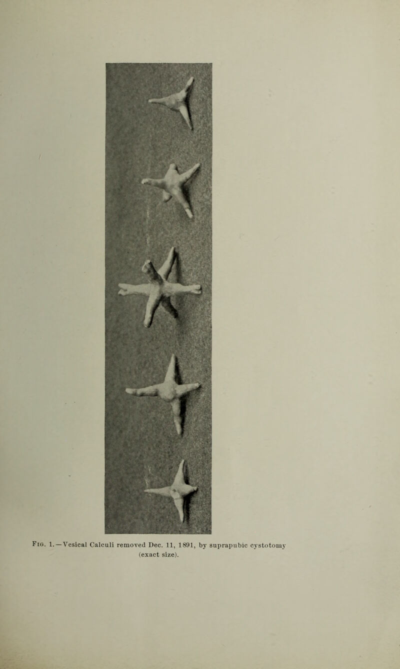 Fig. 1. —Vesical Calculi removed Dec. 11, 1891, by suprapubic cystotomy (exact size).