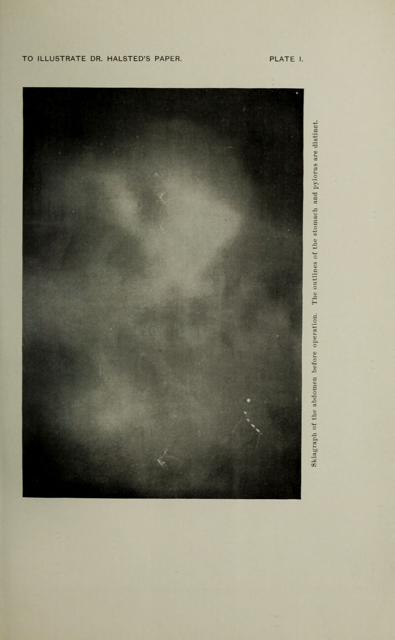 TO ILLUSTRATE DR. HALSTED’S PAPER. PLATE I Skiagraph of the abdomen before operation. The outlines of the stomach and pylorus are distinct.