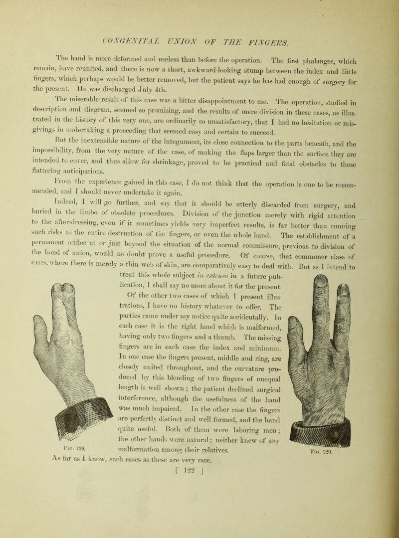 'Hie hand is more deformed and useless than before the operation. The first phalanges, which iemain, lorn* leunited, and there is now a short, awkward-looking stump between the index and little fingers, which perhaps would be better removed, but the patient says he has had enough of surgery for the present. lie was discharged July 4th. 1 he miserable result ot this case was a bitter disappointment to me. The operation, studied in description and diagram, seemed so promising, and the results of mere division in these cases, as illus- trated m the history ot this very one, are ordinarily so unsatisfactory, that I had no hesitation or mis- givings in undertaking a proceeding that seemed easy and certain to succeed. Hut the niextensible nature of the integument, its close connection to the parts beneath, and the impossibility, from the very nature ot the case, of making the flaps larger than the surface they are intended to cover, and thus allow for shrinkage, proved to be practical aud fatal obstacles to these flattering anticipations. From the experience gained in this case, I do not think that the operation is one to be recom- mended, and I should never undertake it again Indeed, I will go further, and say that it should be utterly discarded from surgery, and burned in the limbo of obsolete procedures. Division of the junction merely with rigid attention to the after-dressing, even if it sometimes yields very imperfect results, is far better than running such risks as the entire destruction of the fingers, or even the whole hand. The establishment of a permanent orifice at or just beyond the situation of the normal commissure, previous to division of the bond of union, would no doubt prove a useful procedure. Of course, that commoner class of cases, where there is merely a thin web of skin, are comparatively easy to deal with. But as I intend to treat this whole subject in extenso in a future pub- lication, I shall say no more about it for the present. Of the other two cases of which I present illus- trations, I have no history whatever to offer. The parties came under my notice quite accidentally. In each case it is the right hand which is malformed, having only two fingers and a thumb. The missing fingers are in each case the index and minimum. In one case the fingers present, middle and ring, are closely united throughout, and the curvature pro- duced by this blending of two fingers of unequal length is well shown ; the patient declined surgical interference, although the usefulness of the hand was much impaired. In the other case the fingers are perfectly distinct and well formed, and the hand quite useful. Both of them were laboring men ; the other hands were natural; neither knew of any FlG- lay- malformation among their relatives. Fig. 129. As far as I know, such cases as these are very rare.