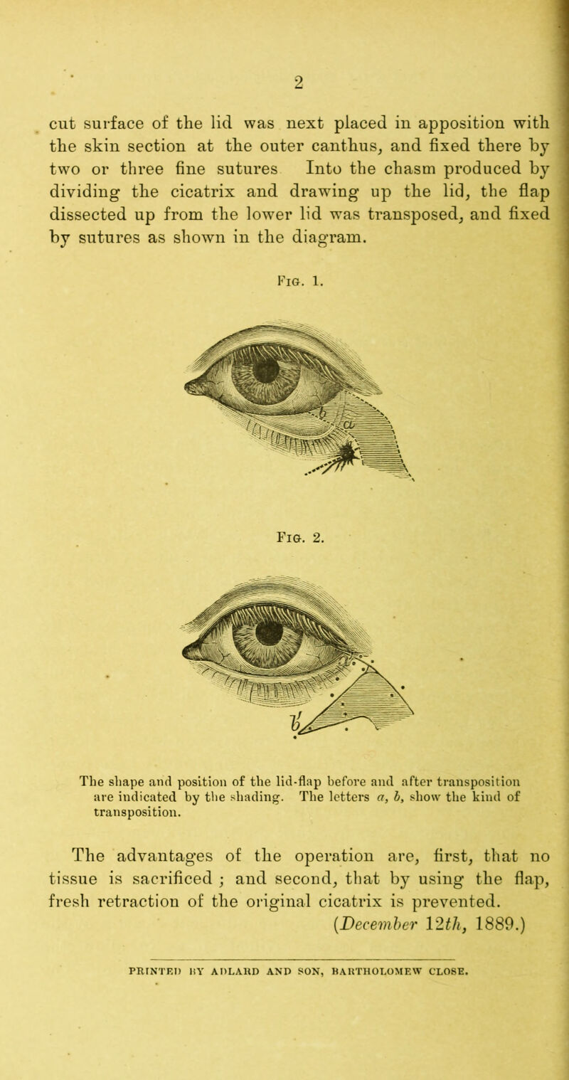 2 cut surface of the lid was next placed in apposition with the skin section at the outer canthus, and fixed there by two or three fine sutures Into the chasm produced by dividing the cicatrix and drawing up the lid, the flap dissected up from the lower lid was transposed, and fixed by sutures as shown in the diagram. Fig. 1. Fig. 2. The shape and position of the lid-flap before and after transposition are indicated by the shading. The letters a, b, show the kind of transposition. The advantages of the operation are, first, that no tissue is sacrificed ; and second, that by using the flap, fresh retraction of the original cicatrix is prevented. (.December 12 th, 1889.) PRJNTEI) BY ADLARD AND SON, BARTHOLOMEW CLOSE.