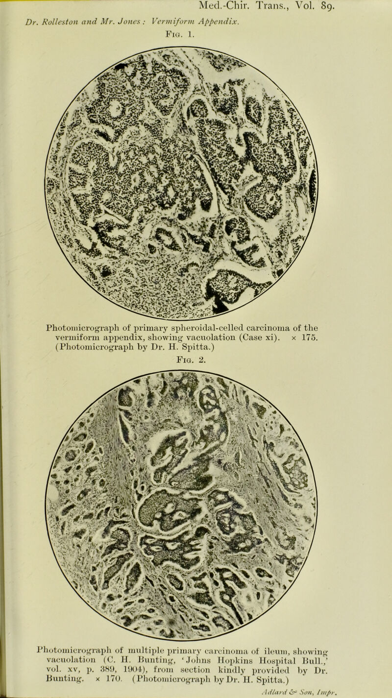 Med.-Chir. Trans., Vol. 89. Dr. Rolleston and Mr. Jones: Vermiform Appendix. Fig. 1. Photomicrograph of primary spheroidal-celled carcinoma of the vermiform appendix, showing vacuolation (Case xi). x 175. (Photomicrograph by Dr. H. Spitta.) Fig. 2. Photomicrograph of multiple primary carcinoma of ileum, showing vacuolation (C. H. Bunting, ‘Johns Hopkins Hospital Bull./ vol. xv, p. 389, 1904), from section kindly provided by Dr. Bunting, x 170. (Photomicrograph by Dr. H. Spitta.) Adlard & Son, Intpr.