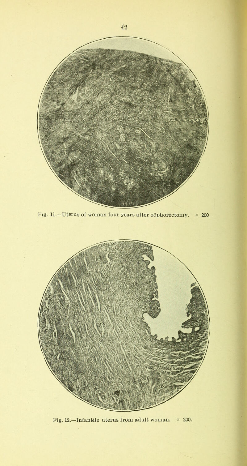 Fig. 11.—Uterus of woman four years after oophorectomy, x 200 Fig. 12.—Infantile uterus from adult woman, x 200.