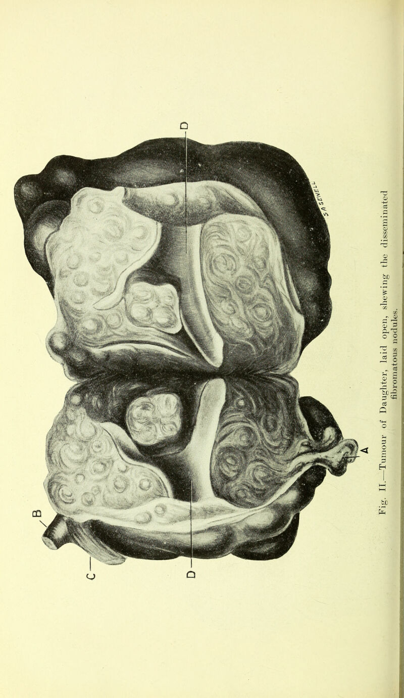 fibromatous nodules.