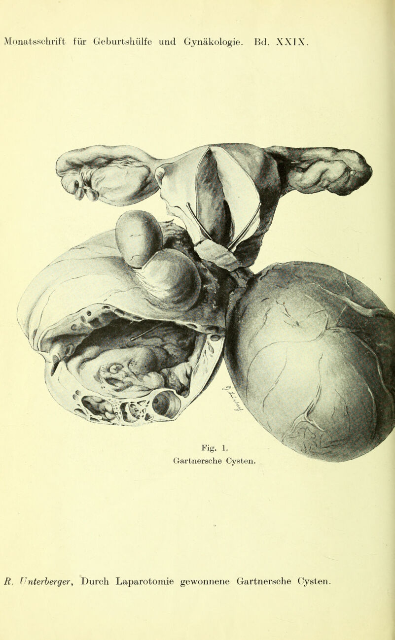 R. ünterbergeTy Durch Laparotomie gewonnene Gartnersche Cysten.