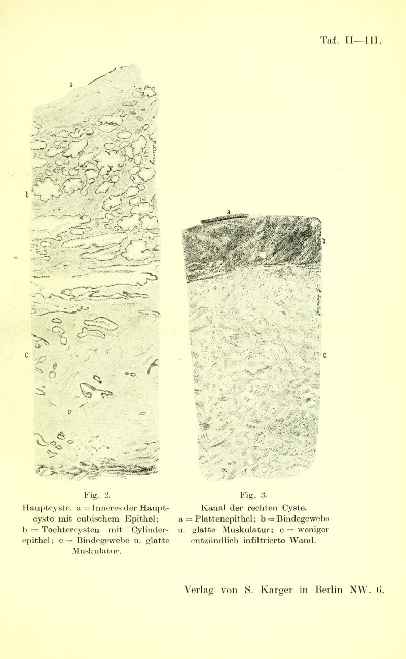 TaL 11—111. 1 Tauyjtcyste. a = Inneres der Haupt- cyste mit cubischem Epithel; b = Tochtercysten mit Cylinder- epithel; c = Bindegewebe u. glatte Muskniatui-. Fig. 3. Kanal der rechten Cyste, a = Plattenepithel; b = Bindegewebe u. glatte Muskulatur; c = weniger entzündlich infiltrierte Wand,