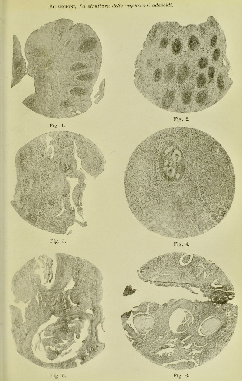 Bi pancioni, La struttura delle vegetazioni adenoidi Fig. 3. Fig. 2. V* Vii' ■& «L ». ■,i}ì*ì3ia i. » ' A;VifcV t .'4 .Wi !?.« Afr M^'ÌRp'C ■ a-. \ a'Jka; ■' -, ■’• A''lS;v'a '/'■ ■ A ' ?; M\ PU? ■ :'■■ 'fj. i Q Fig. 4. Fig. 5. Fig. 3.