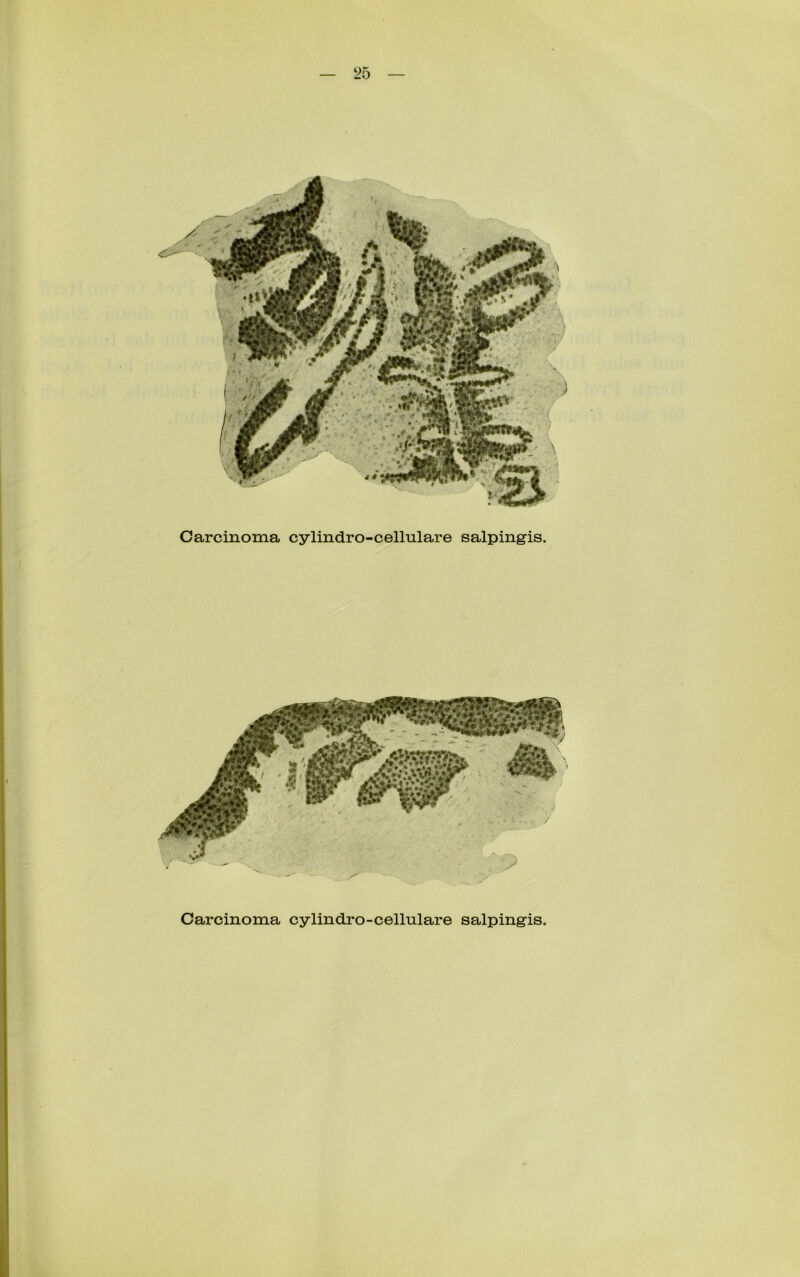 Carcinoma cylindro-cellulare salpingis. Carcinoma cylindro-cellulare salpingis.