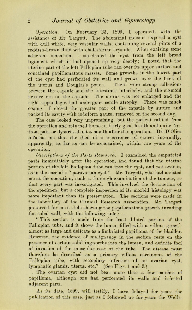 Operation. On February 23, 1899, I operated, with the assistance of Mr. Targett. The abdominal incision exposed a cyst with dull white, very vascular walls, containing several pints of a reddish-brown fluid with cholesterine crystals. After excising some adherent omentum, I enucleated the cyst from the left broad ligament which it had opened up very deeply; I noted that the uterine part of the left Fallopian tube ran over its upper surface and contained papillomatous masses. Some growths in -the lowest part of the cyst had perforated its wall and grown over the back of the uterus and Douglas’s pouch. There were strong adhesions between the capsule and the intestines interiorly, and the sigmoid flexure ran on the capsule. The uterus was not enlarged and the right appendages had undergone senile atrophy. There was much oozing. I closed the greater part of the capsule by suture and packed its cavity with iodoform gauze, removed on the second day. The case looked very unpromising, but the patient rallied from the operation and returned home in fairly good health and quite free from pain or dysuria about a month after the operation. Dr. D’Olier informs me that she died of a recurrence of cancer internally, apparently, as far as can be ascertained, within two years of the operation. Descriptions of the Parts Removed. I examined the amputated parts immediately after the operation, and found that the uterine portion of the left Fallopian tube ran into the cyst, and not over it, as in the case of a “ parovarian cyst.” Mr. Targett, who had assisted me at the operation, made a thorough examination of the tumour, so that every part was investigated. This involved the destruction of the specimen, but a complete inspection of its morbid histology was more important than its preservation. The sections were made in the laboratory of the Clinical Research Association. Mr. Targett preserved for me a slide showing the papillomatous growth invading the tubal wall, with the following note — “ This section is made from the least dilated portion of the Fallopian tube, and it shows the lumen filled with a villous growth almost as large and delicate as a fimbriated papilloma of the bladder. However, the evidence of malignancy in the section rests on the presence of certain solid ingrowths into the lumen, and definite foci of invasion of the muscular coat of the tube. The disease must therefore be described as a primary villous carcinoma of the Fallopian tube, with secondary infection of an ovarian cyst, lymphatic glands, uterus, etc.” (See Figs. 1 and 2.) The ovarian cyst did not bear more than a few patches of papilloma, although one had perforated its walls and infected adjacent parts. As its date, 1899, will testify, I have delayed for years the publication of this case, just as I followed up for years the Wells-