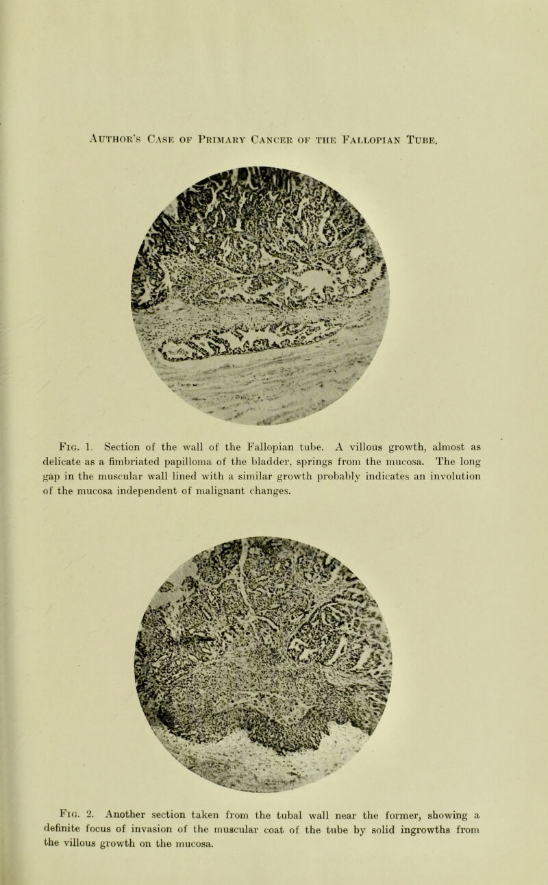 Author’s Case of Primary Cancer of the Fallopian Tube. Fig. 1. Section of the wall of the Fallopian tube. A villoiis growth, almost as delicate as a fimbriated papilloma of the bladder, springs from the mucosa. The long- gap in the muscular wall lined with a similar growth probably indicates an involution of the mucosa independent of malignant changes. Fig. 2. Another section taken from the tubal wall near the former, showing a definite focus of invasion of the muscular coat of the tube by solid ingrowths from the villous growth on the mucosa.