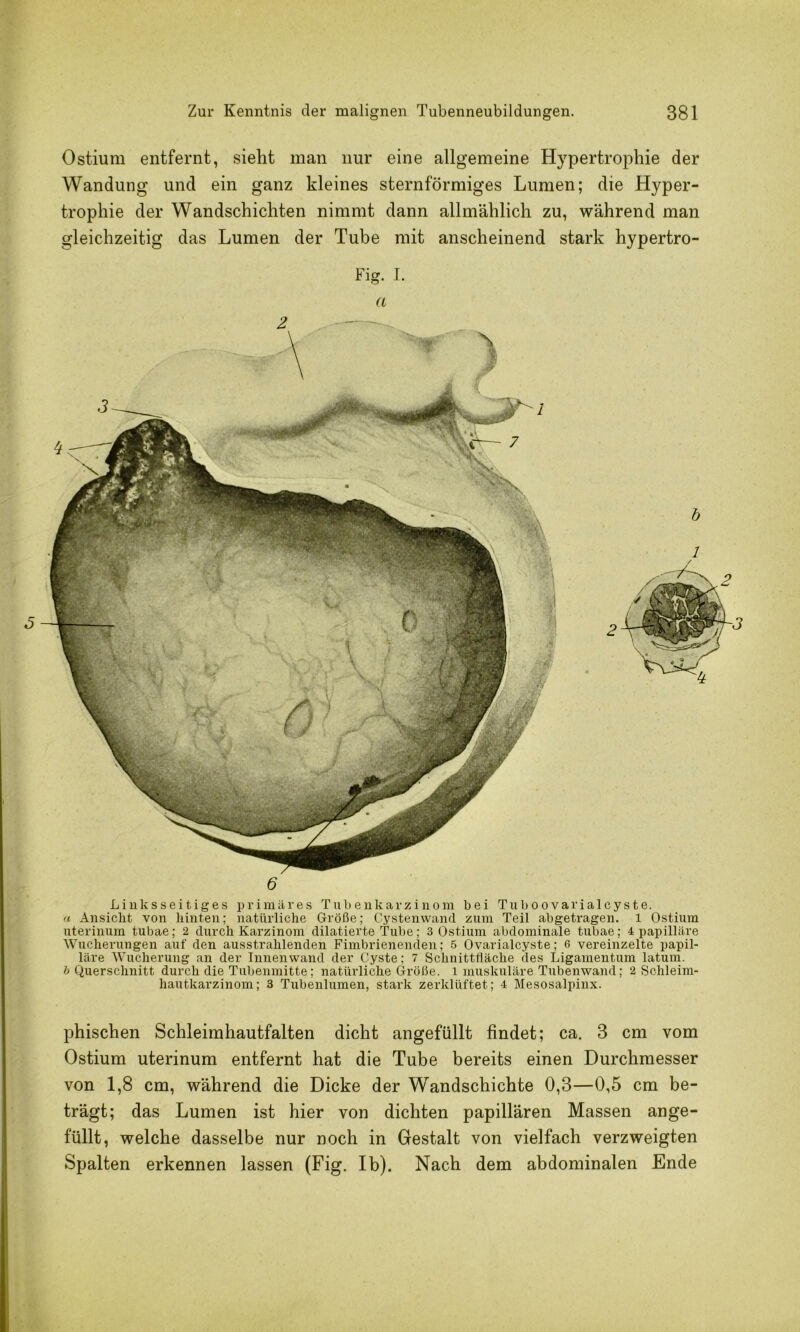 Ostium entfernt, sieht man nur eine allgemeine Hypertrophie der Wandung und ein ganz kleines sternförmiges Lumen; die Hyper- trophie der Wandschichten nimmt dann allmählich zu, während man gleichzeitig das Lumen der Tube mit anscheinend stark hypertro- Fig. I. a 2 6 Linksseitiges x)rimares Tub e uk ar z i n o m bei Tiib o o varial c y s t e. n Ansicht von hinten; natiuiiche Größe; Cystenwand zum Teil abgetragen, i Ostium uterinum tubae; 2 durch Karzinom dilatierte Tube; 3 Ostium abdominale tubae; 4 iiapilläre Wucherungen auf den ausstrahlenden Fimbrienenden; 5 Ovarialcyste; 6 vereinzelte papil- läre Wucherung an der Innenwand der Cyste: 7 Schnittfläche des Ligamentum latum. ^^Querschnitt durch die Tubenmitte; natürliche Größe, i muskuläre Tubenwand; 2 Schleim- hautkarzinom; 3 Tubenlumen, stark zerklüftet; 4 Mesosalpinx. phischen Schleimhautfalten dicht angefüllt findet; ca. 3 cm vom Ostium uterinum entfernt hat die Tube bereits einen Durchmesser von 1,8 cm, während die Dicke der Wandschichte 0,3—0,5 cm be- trägt; das Lumen ist hier von dichten papillären Massen ange- füllt, welche dasselbe nur noch in Gestalt von vielfach verzweigten Spalten erkennen lassen (Fig. Ib). Nach dem abdominalen Ende