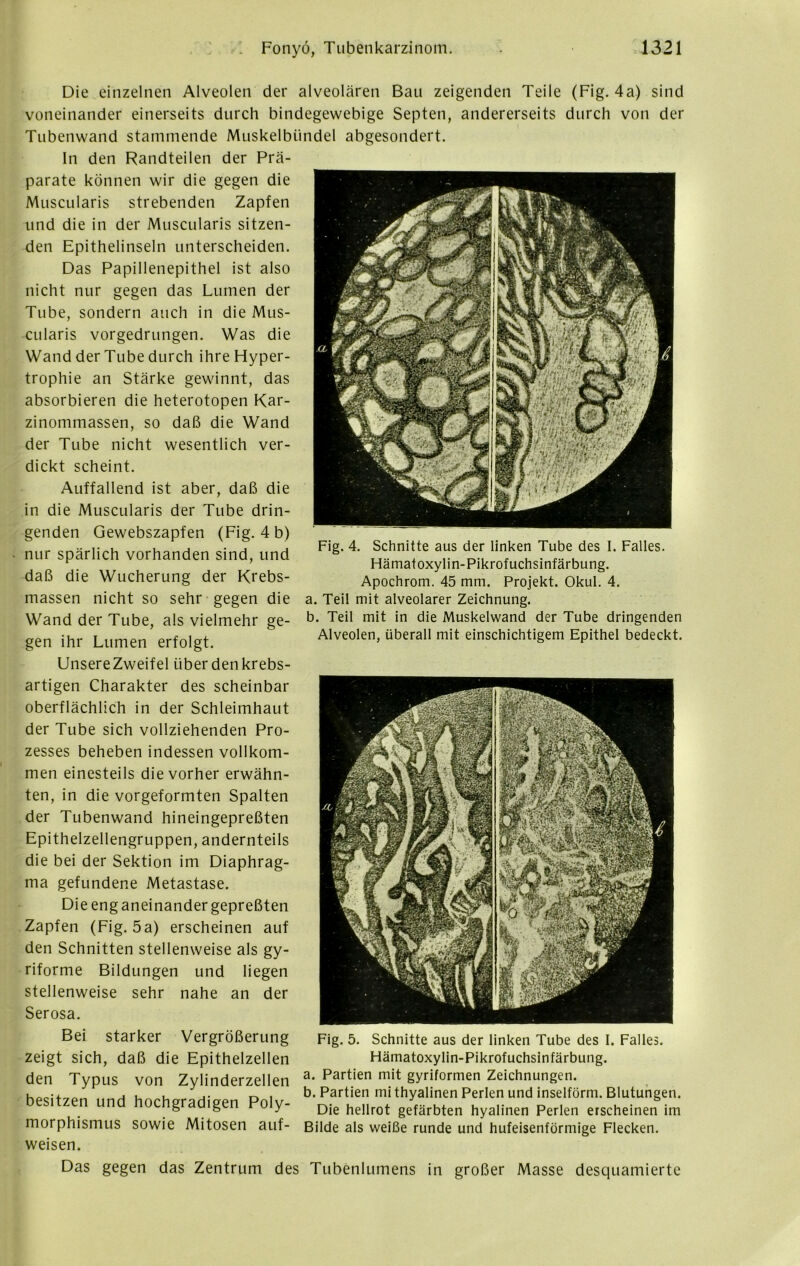 Die einzelnen Alveolen der alveolären Bau zeigenden Teile (Fig. 4a) sind voneinander einerseits durch bindegewebige Septen, andererseits durch von der Tubenwand stammende Muskelbündel abgesondert. In den Randteilen der Prä- parate können wir die gegen die Muscularis strebenden Zapfen und die in der Muscularis sitzen- den Epithelinseln unterscheiden. Das Papillenepithel ist also nicht nur gegen das Lumen der Tube, sondern auch in die Mus- cularis vorgedrungen. Was die Wand der Tube durch ihre Hyper- trophie an Stärke gewinnt, das absorbieren die heterotopen Kar- zinommassen, so daß die Wand der Tube nicht wesentlich ver- dickt scheint. Auffallend ist aber, daß die in die Muscularis der Tube drin- genden Gewebszapfen (Fig. 4 b) nur spärlich vorhanden sind, und daß die Wucherung der Krebs- massen nicht so sehr gegen die Wand der Tube, als vielmehr ge- gen ihr Lumen erfolgt. UnsereZweifel über denkrebs- artigen Charakter des scheinbar oberflächlich in der Schleimhaut der Tube sich vollziehenden Pro- zesses beheben indessen vollkom- men einesteils die vorher erwähn- ten, in die vorgeformten Spalten der Tubenwand hineingepreßten Epithelzellengruppen, andernteils die bei der Sektion im Diaphrag- ma gefundene Metastase. Die eng aneinander gepreßten Zapfen (Fig. 5a) erscheinen auf den Schnitten stellenweise als gy- riforme Bildungen und liegen stellenweise sehr nahe an der Serosa. Bei starker Vergrößerung zeigt sich, daß die Epithelzellen den Typus von Zylinderzellen besitzen und hochgradigen Poly- morphismus sowie Mitosen auf- weisen. Das gegen das Zentrum des Tubenlumens in großer Masse desquamierte Fig. 4. Schnitte aus der linken Tube des I. Falles. Hämatoxylin-Pikrofuchsinfärbung. Apochrom. 45 mm. Projekt. Okul. 4. a. Teil mit alveolarer Zeichnung. b. Teil mit in die Muskelwand der Tube dringenden Alveolen, überall mit einschichtigem Epithel bedeckt. Fig. 5. Schnitte aus der linken Tube des I. Falles. Hämatoxylin-Pikrofuchsinfärbung. a. Partien mit gyriformen Zeichnungen. b. Partien mi thyalinen Perlen und inselförm. Blutungen. Die hellrot gefärbten hyalinen Perlen erscheinen im Bilde als weiße runde und hufeisenförmige Flecken.