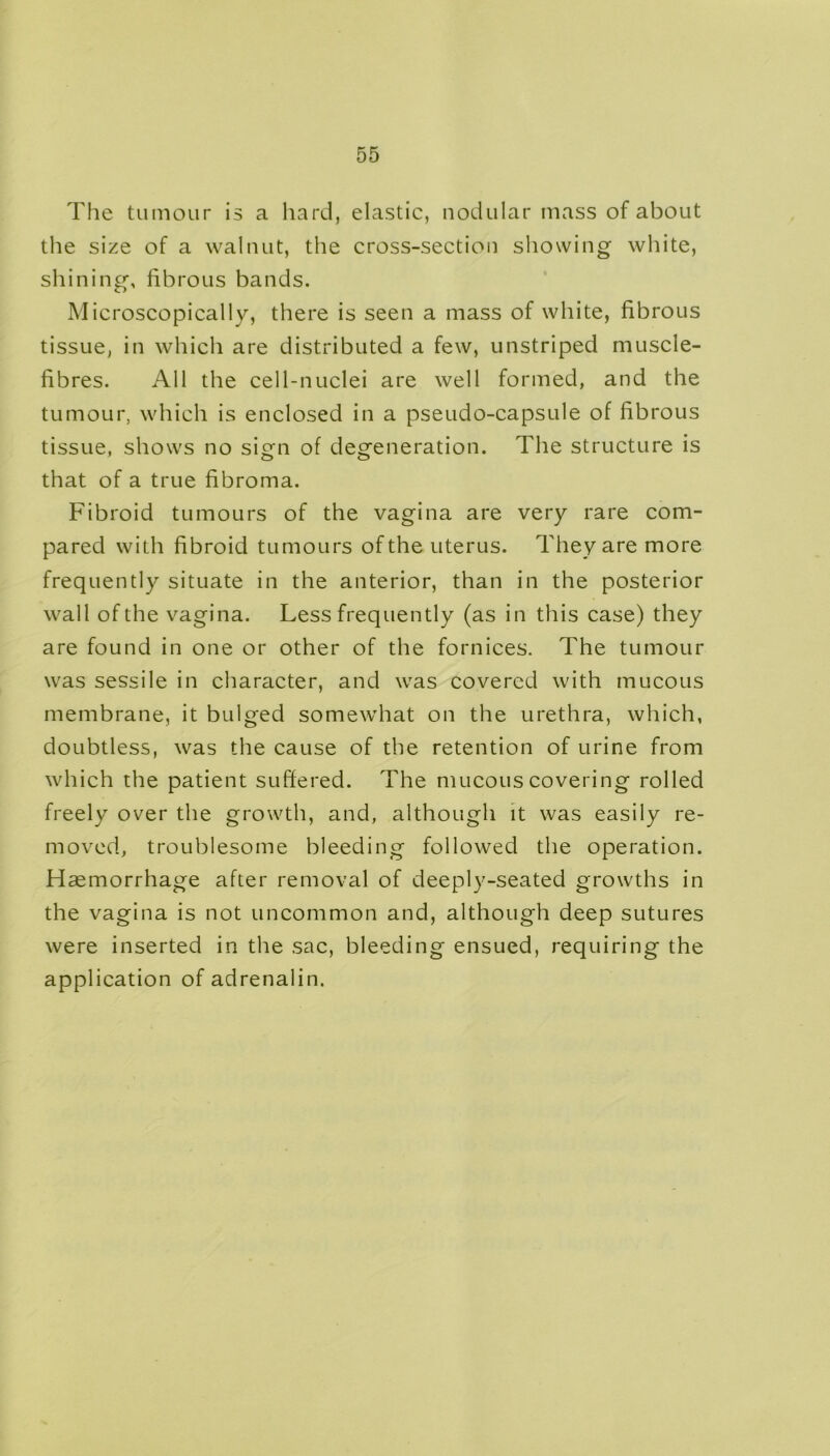 The tumour is a hard, elastic, nodular mass of about the size of a walnut, the cross-section showing white, shining, fibrous bands. Microscopically, there is seen a mass of white, fibrous tissue, in which are distributed a few, unstriped muscle- fibres. All the cell-nuclei are well formed, and the tumour, which is enclosed in a pseudo-capsule of fibrous tissue, shows no sign of degeneration. The structure is that of a true fibroma. Fibroid tumours of the vagina are very rare com- pared with fibroid tumours of the uterus. They are more frequently situate in the anterior, than in the posterior wall of the vagina. Less frequently (as in this case) they are found in one or other of the fornices. The tumour was sessile in character, and was covered with mucous membrane, it bulged somewhat on the urethra, which, doubtless, was the cause of the retention of urine from which the patient suffered. The mucous covering rolled freely over the growth, and, although it was easily re- moved, troublesome bleeding followed the operation. Haemorrhage after removal of deeply-seated growths in the vagina is not uncommon and, although deep sutures were inserted in the sac, bleeding ensued, requiring the application of adrenalin.