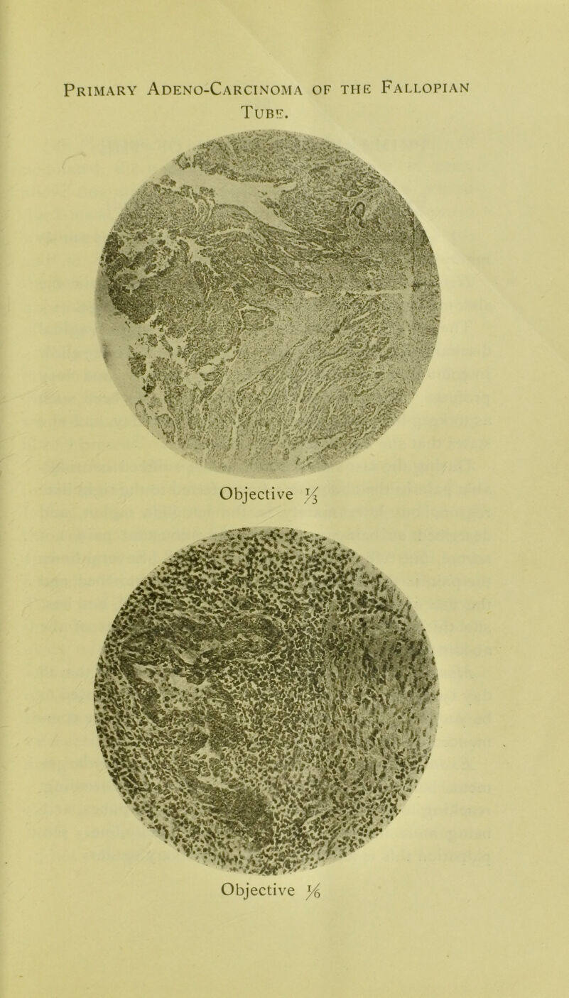 'kMSmm . Primary Adeno-Carcinoma of the Fallopian Tube. Objective Objective ^