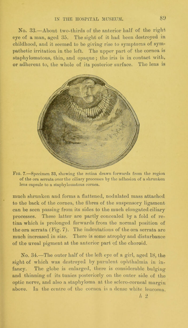 No. 33.—About two-thirds of the anterior half of the right eye of a man, aged 35. The sight of it had been destroyed in childhood, and. it seemed to be giving rise to symptoms of sym- pathetic irritation in the left. The upper part of the cornea is staphylomatous, thin, and opaque ; the iris is in contact with, or adhei’ent to, the whole of its posterior surface. The lens is Fig. 7.—Specimen 33, showing the retina drawn forwards from the region of the ora serrata over the ciliary pi’ocesses by the adhesion of a shrunken lens capsule to a staphylomatous cornea. much shrunken and forms a flattened, nodulated mass attached, to the back of the cornea, the fibres of the suspensory ligament can be seen passing from its sides to the much elongated ciliaiy processes. These latter ai’e partly concealed by a fold of re- tina which is prolonged forwards from the normal position of the ora serrata (ihg. 7). The indentations of the ora serrata arc much increased in size. There is some atrophy and disturbance of the uveal pigment at the anterior part of the choroid. No, 34.—The outer half of the left eye of a girl, aged 18, the sight of which Avas destroyed by purulent ophthalmia in in- fancy. The globe is enlarged, there is considerable bulging and thinning of its tunics posteriorly on the outer side of the optic nerve, and also a stajihyloraa at the sclero-oorneal margin above. In the centre of the cornea is a dense white leiiconia. h 2