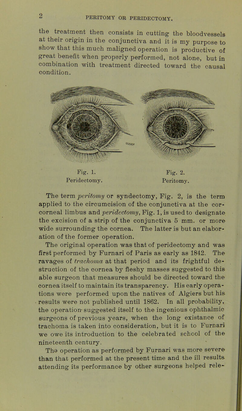 the treatment then consists in cutting the bloodvessels at their origin in the conjunctiva and it is my purpose to show that this much maligned operation is productive of great benefit when properly performed, not alone, but in combination with treatment directed toward the causal condition. Fig. 1. Fig. 2. Peridectomy. Peritomy. The term peritomy or syndectomy, Fig. 2, is the term applied to the circumcision of the conjunctiva at the cor- corneal limbus and peridectomy, Fig. 1, is used to designate the excision of a strip of the conjunctiva 5 mm. or more wide surrounding the cornea. The latter is but an elabor- ation of the former operation. The original operation was that of peridectomy and was first performed by Furnari of Paris as early as 1842. The ravages of trachoma at that period and its frightful de- struction of the cornea by fleshy masses suggested to this able surgeon that measures should be directed toward the cornea itself to maintain its transparency. His early opera- tions were performed upon the natives of Algiers but his results were not published until 1862. In all probability, the operation-suggested itself to the ingenious ophthalmic surgeons of previous years, when the long existance of trachoma is taken into consideration, but it is to Furnari we owe its introduction to the celebrated school of the nineteenth century. The operation as performed by Furnari was more severe than that performed at the present time and the ill results attending its performance by other surgeons helped rele-