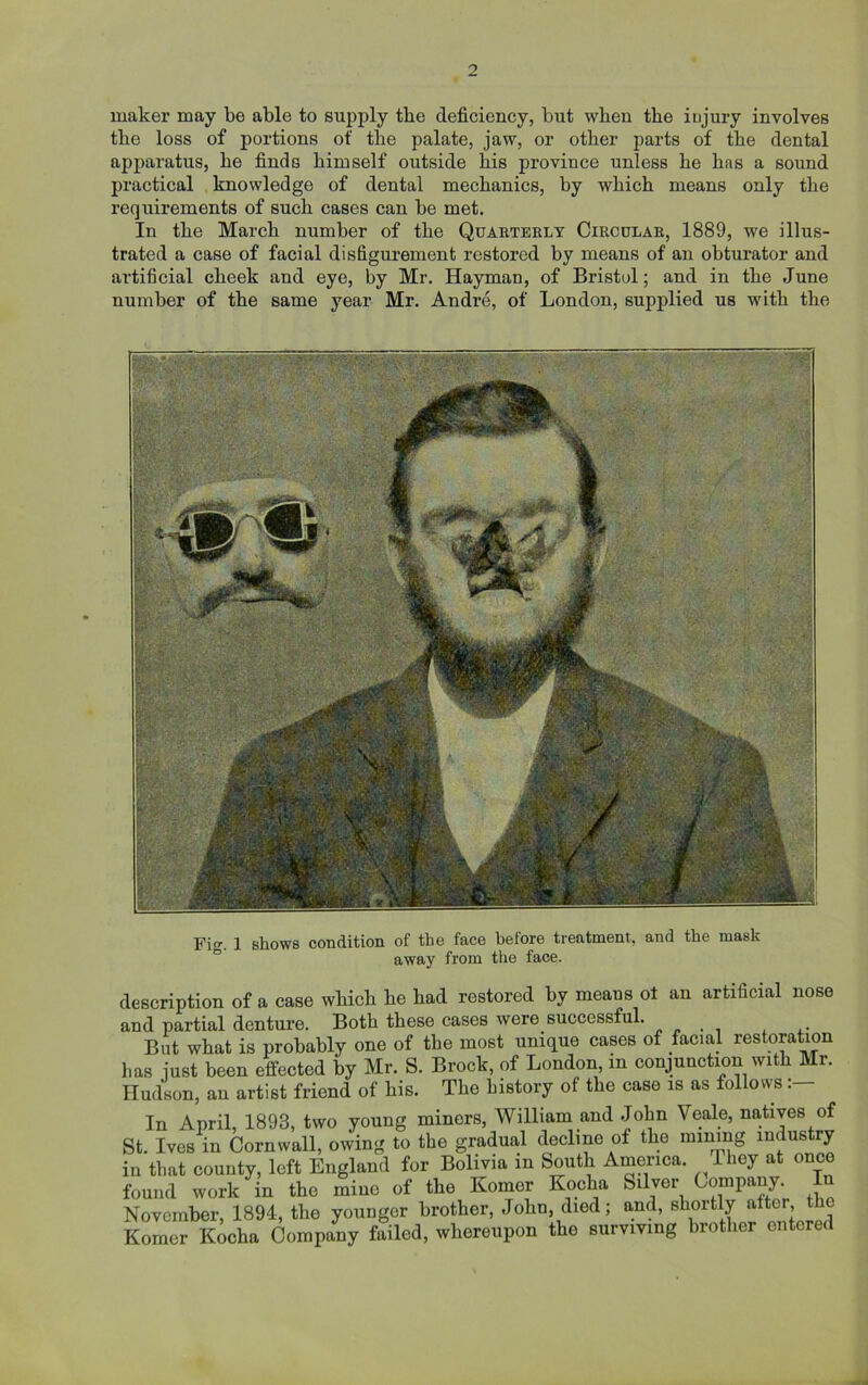 maker may be able to supply tbe deficiency, but wben the injury involves tbe loss of portions of the palate, jaw, or other parts of the dental apparatus, he finds himself outside his province unless he has a sound practical knowledge of dental mechanics, by which means only the requirements of such cases can be met. In the March number of the Quarterly Circular, 1889, we illus- trated a case of facial disfigurement restored by means of an obturator and artificial cheek and eye, by Mr. Hayman, of Bristol; and in the June number of the same year Mr. Andre, of London, supplied us with the Fi<r. 1 shows condition of the face before treatment, and the mask away from the face. description of a case which he had restored by means ot an artificial nose and partial denture. Both these cases were successful. But what is probably one of the most unique cases of facial restoration has just been effected by Mr. S. Brock, of London, in conjunction with Mr. Hudson, an artist friend of his. The history of the case is as follows: In April, 1893, two young miners, William and John Veale, natives of St. Ives in Cornwall, owing to the gradual decline of the mining industry in that county, left England for Bolivia in South America. They at once found work in the mine of the Komer Kocha Silver Company. In November, 1894, the younger brother, John, died; and, shortly after the Komer Kocha Company failed, whereupon the surviving brother entered