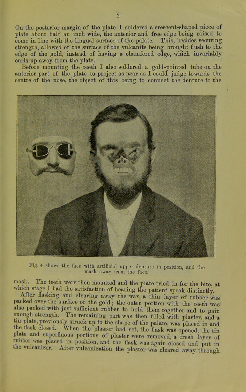 On the posterior margin of the plate I soldered a crescent-shaped piece of plate about half an inch wide, the anterior and free edge being raised to come in line with the lingual surface of the palate. This, besides securing strength, allowed of the surface of the vulcanite being brought flush to the edge of the gold, instead of having a chamfered edge, which invariably curls up away from the plate. Before mounting the teeth I also soldered a gold-pointed tube on the anterior part of the plate to project as near as I could judge towards the centre of the nose, the object of this being to connect the denture to the lig. 4 shows the face with artificial upper denture in position, and the mask away from the face. mask. The teeth were then mounted and the plate tried in for the bite, at which stage I had the satisfaction of hearing the patient speak distinctly. After flasking and clearing away the wax, a thin layer of rubber was packed over the surface of the gold; the outer portion with the teeth was also packed with just sufficient rubber to hold them together and to gain enough strength. The remaining part was then filled with plaster, and a tin plate, previously struck up to the shape of the palate, was placed in and the flask closed. When the plaster had set, the flask was opened, the tin plate and superfluous portions of plaster were removed, a fresh layer of rubber was placed m position, and the flask was again closed and put in tke vulcamzer. After vulcanization the plaster was cleared away through