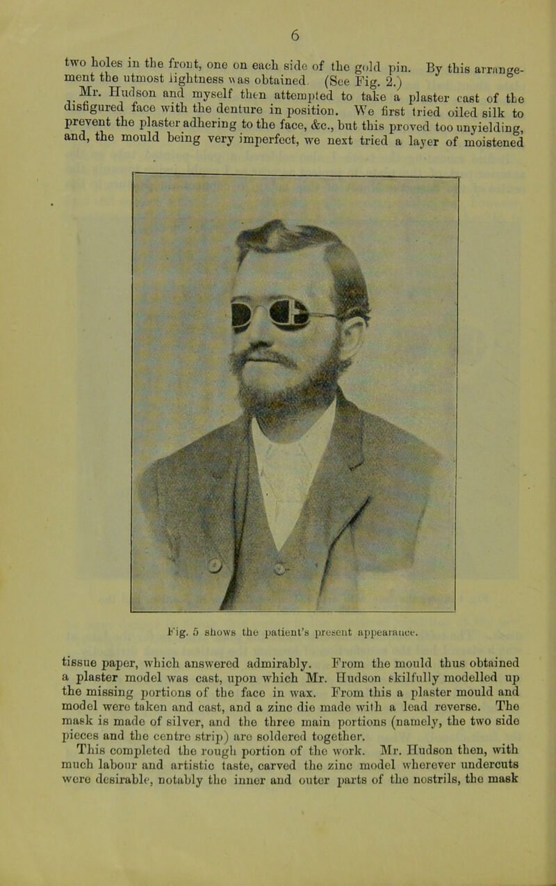 two holes in the front, one on each side of the gold pin. By this arrange- ment the utmost lightness was obtained (See Fig. 2.) Mr. Hudson and myself then attempted to take a plaster cast of the disfigured face with the denture in position. We first tried oiled silk to prevent the plaster adhering to the face, &c., but this proved too unyielding, and, the mould being very imperfect, we next tried a layer of moistened Fig. 5 shows the patient’s present appearance. tissue paper, -which answered admirably. From the mould thus obtained a plaster model was cast, upon -which Mr. Hudson skilfully modelled up the missing portions of the face in wax. From this a plaster mould and model wero taken and cast, and a zinc die made with a lead reverse. The mask is made of silver, and the three main portions (namely, the two side pieces and the centre strip) are soldered together. This completed the rough portion of tho work. Mr. Hudson then, with much labour and artistic taste, carved tho zinc model wherever undercuts were desirable, notably tho inner and outer parts of tho nostrils, the mask