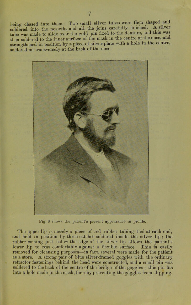 bein<* chased into them. Two small silver tubes were then shaped and soldered into the nostrils, and all the joins carefully finished. A silver tube was made to slide over the gold pin fixed to the denture, and this was then soldered to the inner surface of the mask in the centre of the nose, and strengthened in position by a piece of silver plate with a hole in the centre, soldered on transversely at the back of the nose. Fig. 6 sliows the patient’s present appearance in profile. The upper lip is merely a piece of red rubber tubing tied at each end, and held in position by three catches soldered inside the silver lip ; the rubber coming just below the edge of the silver lip allows the patient’s lower lip to rest comfortably against a flexible surface. This is easily removed for cleansing purposes—in fact, several were made for the patient as a store. A strong pair of blue silver-framed goggles with the ordinary retractor fastenings behind the head were constructed, and a small pin was soldered to the back of the centre of the bridge of the goggles ; this pin fits into a hole made in the mask, thereby preventing tho goggles from slipping.