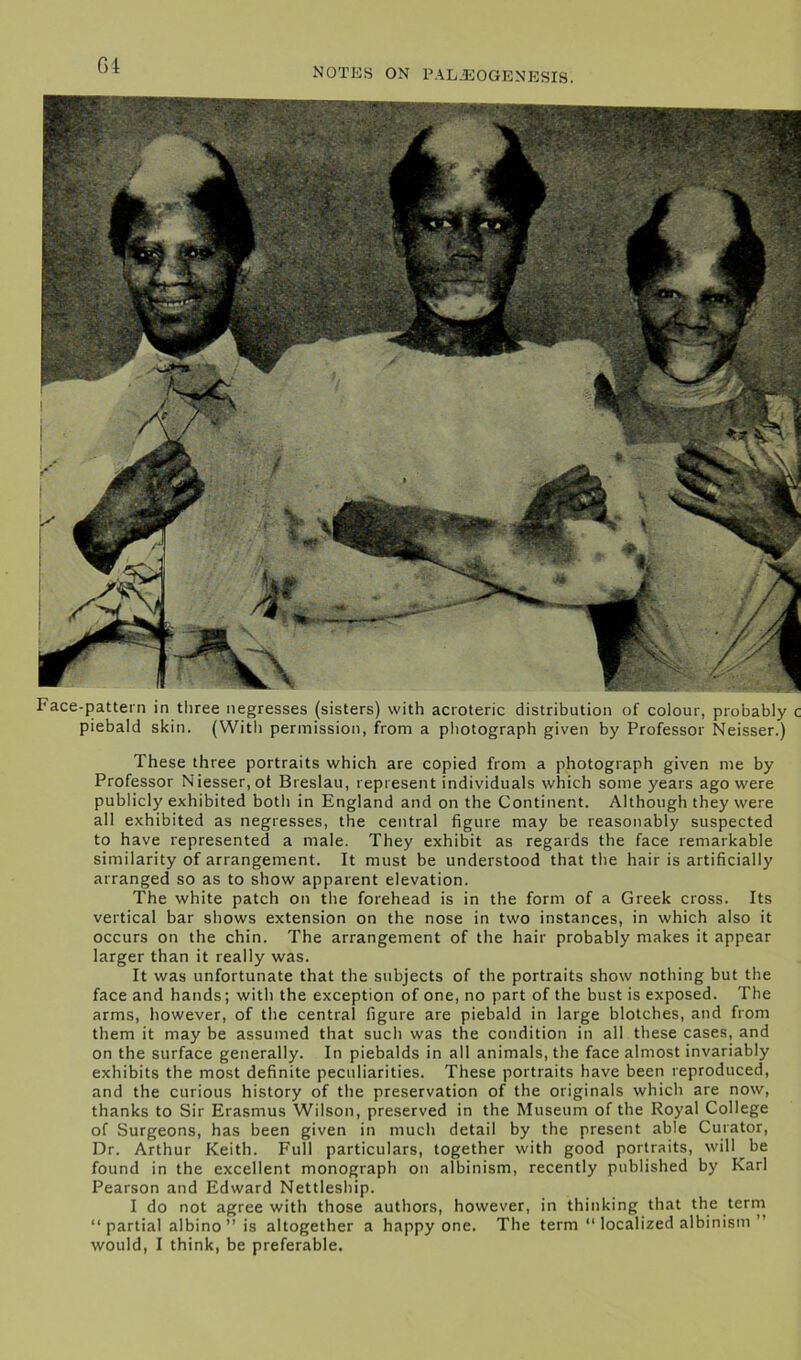 Gi NOTES ON PALEOGENE SIS. Pace-pattern in three negresses (sisters) with acroteric distribution of colour, probably c piebald skin. (With permission, from a photograph given by Professor Neisser.) These three portraits which are copied from a photograph given me by Professor Niesser, ot Breslau, represent individuals which some years ago were publicly exhibited both in England and on the Continent. Although they were all exhibited as negresses, the central figure may be reasonably suspected to have represented a male. They exhibit as regards the face remarkable similarity of arrangement. It must be understood that the hair is artificially arranged so as to show apparent elevation. The white patch on the forehead is in the form of a Greek cross. Its vertical bar shows extension on the nose in two instances, in which also it occurs on the chin. The arrangement of the hair probably makes it appear larger than it really was. It was unfortunate that the subjects of the portraits show nothing but the face and hands; with the exception of one, no part of the bust is exposed. The arms, however, of the central figure are piebald in large blotches, and from them it may be assumed that such was the condition in all these cases, and on the surface generally. In piebalds in all animals, the face almost invariably exhibits the most definite peculiarities. These portraits have been reproduced, and the curious history of the preservation of the originals which are now, thanks to Sir Erasmus Wilson, preserved in the Museum of the Royal College of Surgeons, has been given in much detail by the present able Curator, Dr. Arthur Keith. Full particulars, together with good portraits, will be found in the excellent monograph on albinism, recently published by Karl Pearson and Edward Nettleship. I do not agree with those authors, however, in thinking that the term “partial albino” is altogether a happy one. The term “ localized albinism ” would, I think, be preferable.