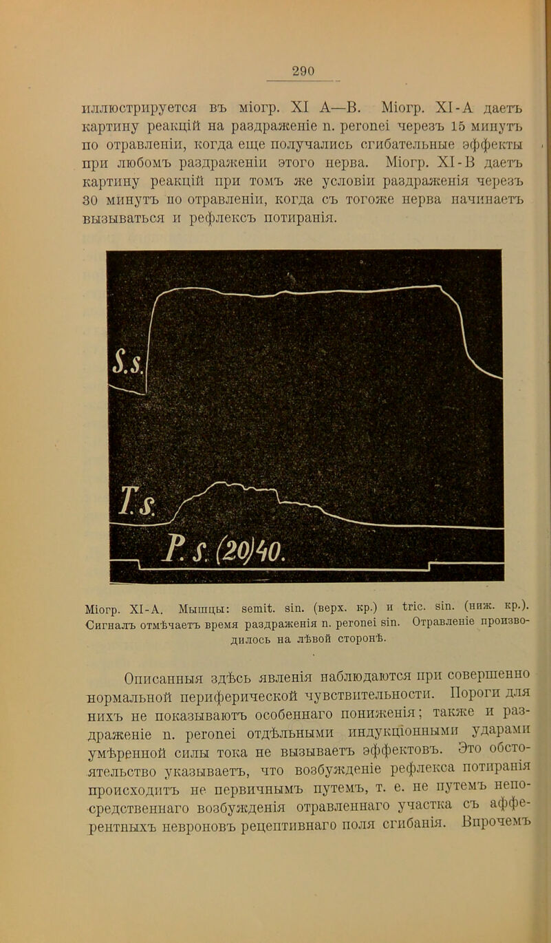 iiJiJiiocTpiipyeTCii bod Miorp. XI A—B. Miorp. XI-A jiaeTij KapTHHy peaivpitt na pa3;i;paa«eiiie n. peronei ■^lepes'b 15 Mimyrh no OTpaBJieniii, KorAa euj,e nojiynajmcL crnOaTejibUbie 9(f)(|)e[a’bi npn JiioSoMT) paanpajiteniii 9Toro iiepBa. Miorp. XI-B jiaeiB KapTimy peaKpifl npn tom-b Mte ycjioBin pas/ipaji^eHin nepesB 30 MimyTB no OTpaBJiemii, Kor^a cb Torome nepBa naniinaeTB BH3HBaTbCH II pe^uiOKCB noTiipaHin. Miorp. XI-A. Muinau: semit. sin. (nepx. Kp.) n trie. sin. (nnac. np.). CnmajiT) OTMlmaeTt speMa pas^npaHcenia n. peronei sin. OrpaBaenie nponsBO- niiJiocB na Ji'feBOfl CToponife. Oni'icaHHbm 3.iyl>cb nBJieHin naOjiionaioTcn iipii coBepineHHO HopMajibHoIt nepii(|)epiinecKolI nyBCTBiiTejibHocTii. Iloporn hji^i HiixB EG noKasHBaioTB ocoOeHHaro noHiiJKeHiE; TaKsite h pa3- UpajKonie n. peronei orn'feJibHbiMH HHEyKiiioHiibiMii yAapanii yM'bpeHHoIi chjibi Toita ne BHObiBaeTB 9(|i(|)eKT0BB. 3to o6cto- nrejibCTBO yKaobiBaerB, eto BoeOyntrioHie pe(|)JieKca noTiipaHin npoHcxoAETB He nepBHEHHMB nyieMB, t. e. ne nyreMB neno- cpencTBeiiHaro BoeOyncT^eHin oTpaBJieHHaro ynacTKa cb a(|)(|)e- peHTHHXB iieBpoHOBB pepeiiTiiBHaro nojm criiOaHin. BnponeMB