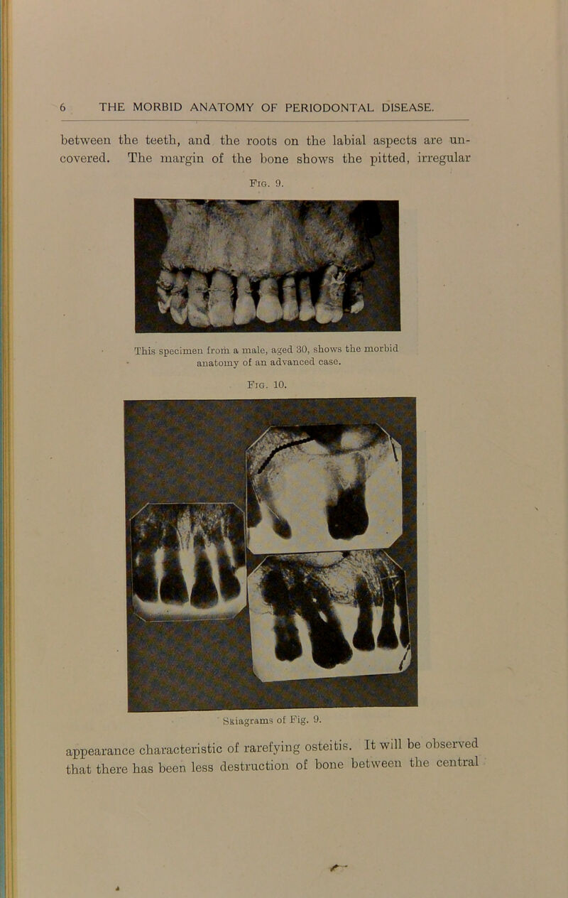 between the teeth, and the roots on the labial aspects are un- covered. The margin of the bone shows the pitted, irregular Pig. 9. This specimen from a male, aged 30, shows the morbid anatomy of an advanced case. Fig. 10. Skiagrams of Pig. 9. appearance characteristic of rarefying osteitis. It will be observed that there has been less destruction of bone between the central