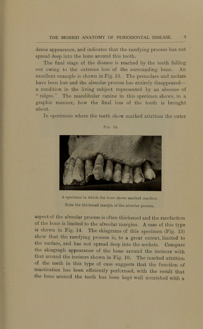 dense appearance, and indicates that the rarefying process has not spread deep into the bone around this tooth. The final stage of the disease is reached hy the teeth falling out owing to the extreme loss of the surrounding bone. An excellent example is shown in Fig. 13. The premolars and molars have been lost and the alveolar process has entirely disappeared— a condition in the living subject represented by an absence of “ridges.” The mandibular canine in this specimen shows, in a graphic manner, how the final loss of the tooth is brought about. In specimens where the teeth show marked attrition the outer Fig. 14. A specimen in which the bone shows marked reaction. Note the thickened margin of the alveolar process. aspect of the alveolar process is often thickened and the rarefaction of the Done is limited to the alveolar margins. A case of this t3rpe is shown in Fig. 14. The skiagrams of this specimen (Fig. 15) show that the rarefying process is, to a great extent, limited to the surface, and has not spread deep into the sockets. Compare the skiagraph appearance of the bone around the incisors with that around the incisors shown in Fig. 10. The marked attrition of the teeth in this type of case suggests that the function of mastication has been efficiently performed, with the result that the bone around the teeth has been kept well nourished with a