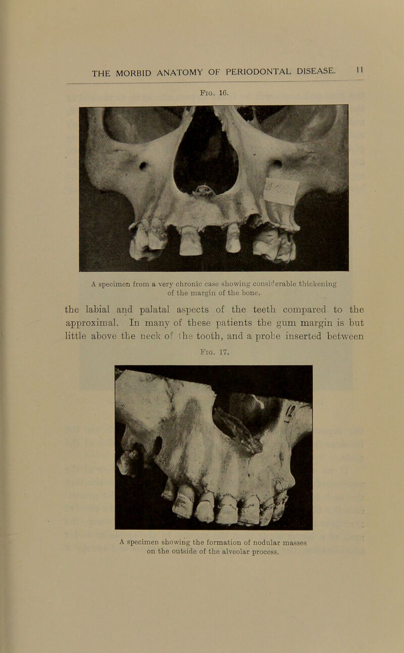 Pig. 16. A specimen from a very chronic case showing considerable thickening of the margin of the bone. the labial and palatal aspects of the teeth compared to the approximal. In many of these patients the gum margin is but little above the neck of the tooth, and a probe inserted between Fig. 17. A specimen showing the formation of nodular masses on the outside of the alveolar process.