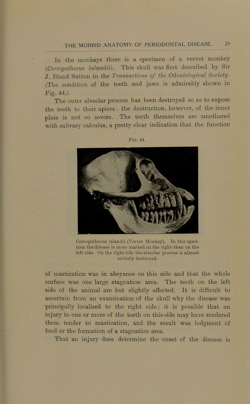 In the monkeys there is a specimen of a vervet monkey (■Cercopethecus lalandii). This skull was first described by Sir J. Bland Sutton in the Transactions of the Odontological Society. (The condition of the teeth and jaws is admirably shown in Fig. 44.) The outer alveolar process has been destroyed so as to expose the teeth to their apices : the destruction, however, of the inner plate is not so severe. The teeth themselves are smothered with salivary calculus, a pretty clear indication that the function Fig. 44. Cercopethecus lalandii (Vervet Monkey). In this speci- men the disease is more marked on the right than on the left side. On the right side the alveolar process is almost entirely destroyed. of mastication was in abeyance on this side and that the whole surface was one large stagnation area. The teeth on the left side of the animal are but slightly affected. It is difficult to ascertain from an examination of the skull why the disease was principally localised to the right side; it is possible that an injury to one or more of the teeth on this side may have rendered them tender to mastication, and the result was lodgment of food or the formation of a stagnation area. That an injury does determine the onset of the disease is